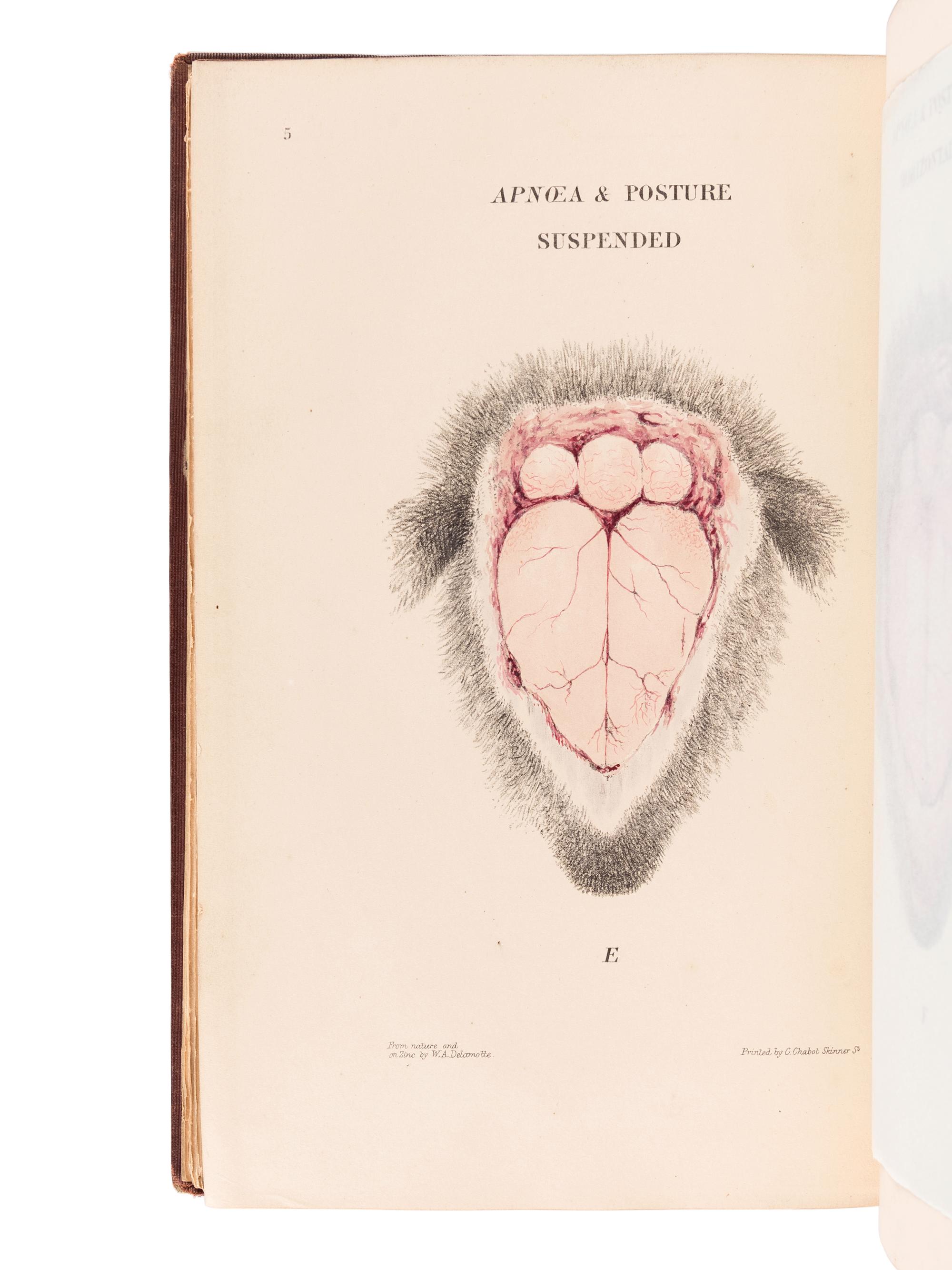 BURROWS, George (1832-1909). On Disorders of the Cerebral Circulation; And on the Connection between Affections of the Brain and Diseases of the Heart. London: Longman, Brown, Green, and Longmans, 1846.