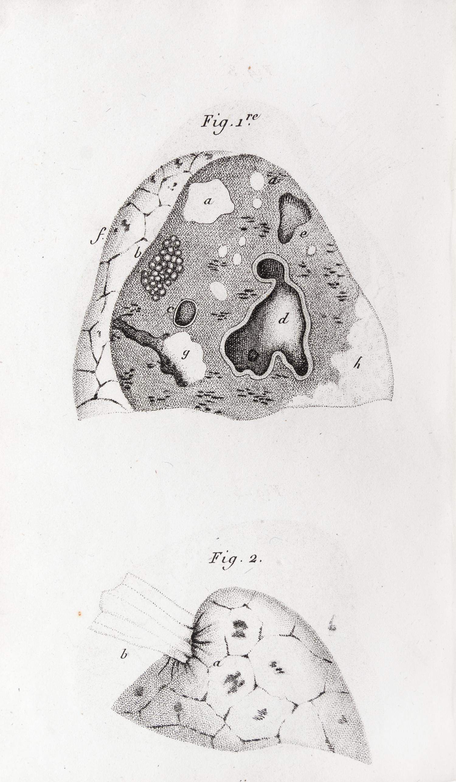 LAENNEC, R.T. Traite de L'Auscultation mediate... Paris, 1826. 2 vols. Second edition.