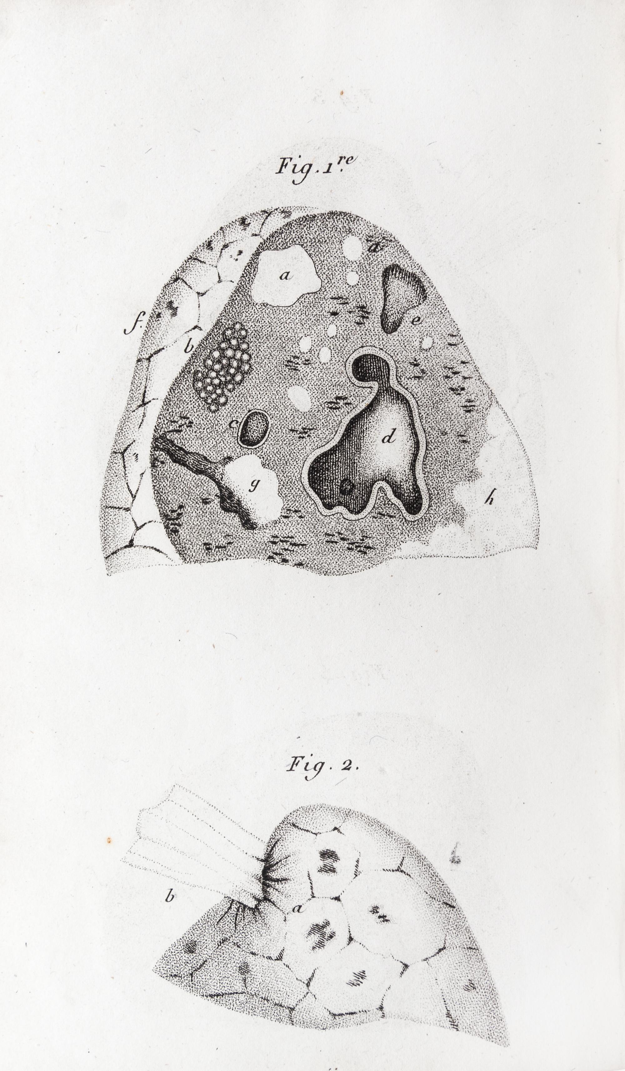 LAENNEC, R.T. Traite de L'Auscultation mediate... Paris, 1826. 2 vols. Second edition.