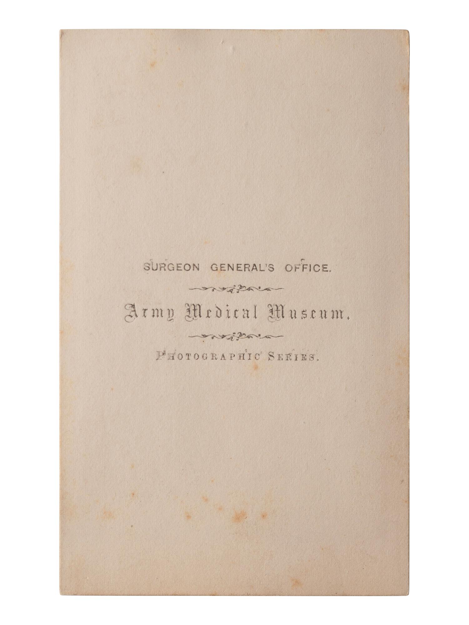 [CIVIL WAR]. A group of 5 CDVs of medical specimens issued by the Surgeon General's Office, Army Medical Museum. [Washington, DC], ca 1860s.