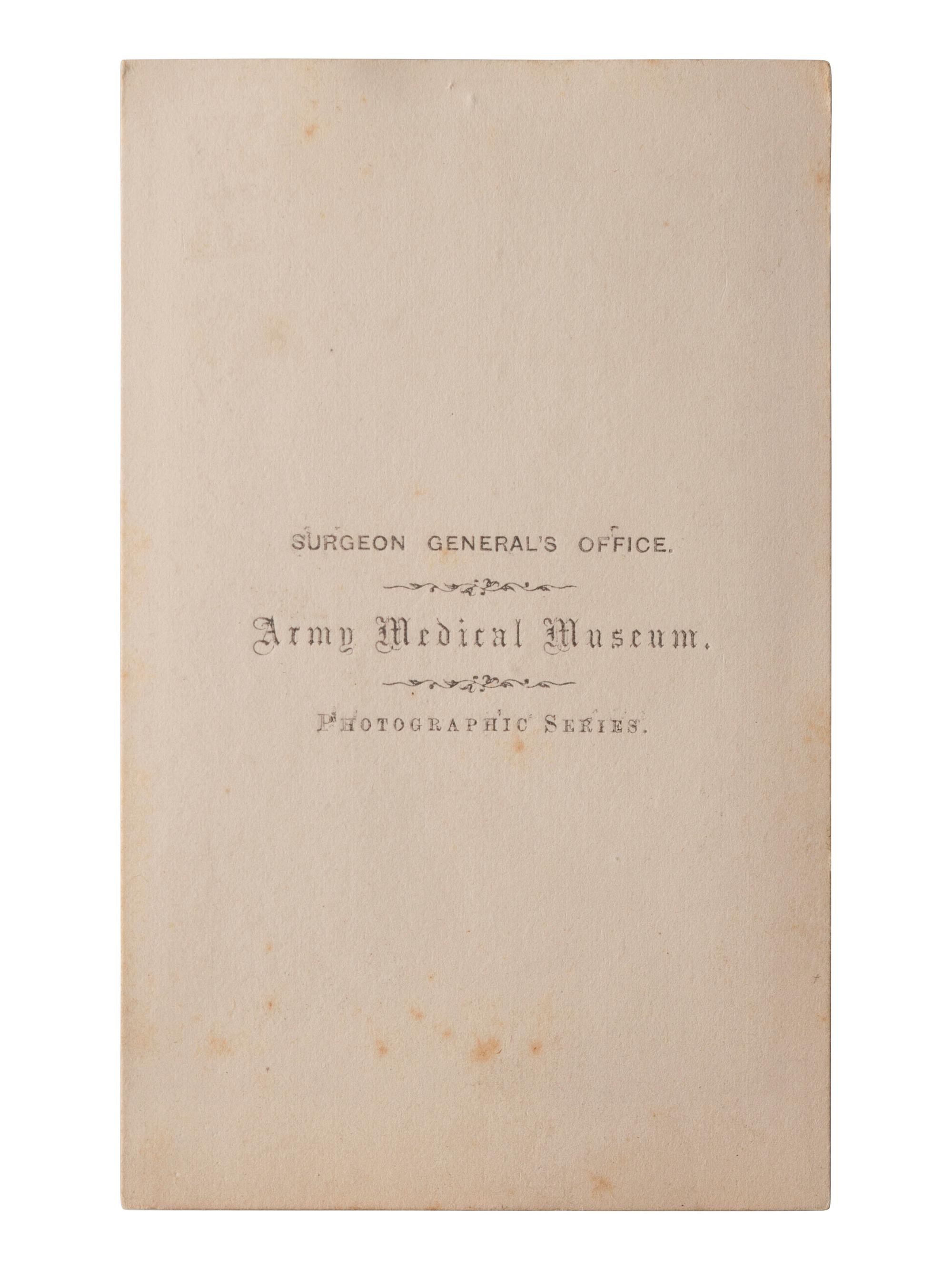 [CIVIL WAR]. A group of 5 CDVs of medical specimens issued by the Surgeon General's Office, Army Medical Museum. [Washington, DC], ca 1860s.