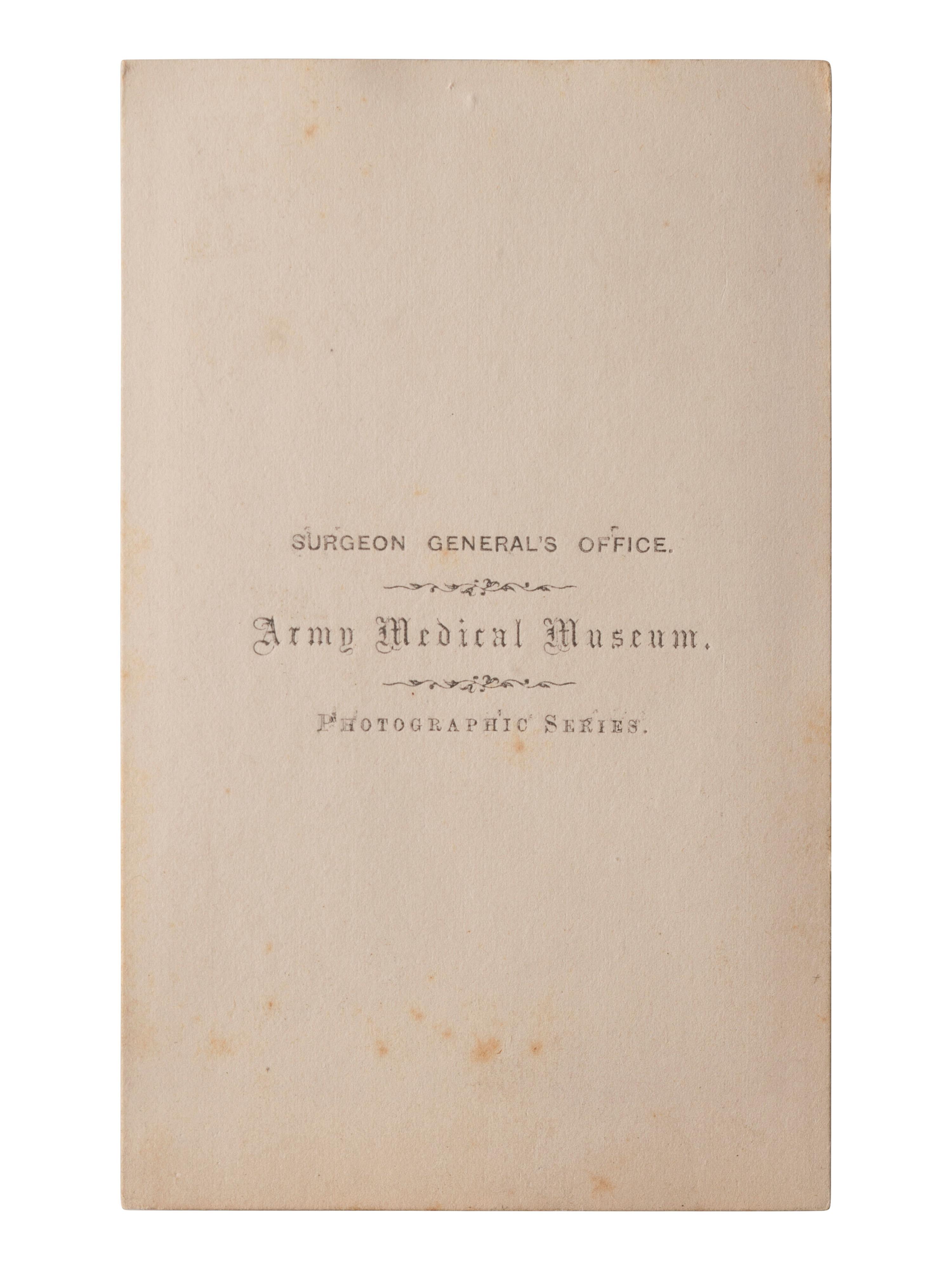 [CIVIL WAR]. A group of 5 CDVs of medical specimens issued by the Surgeon General's Office, Army Medical Museum. [Washington, DC], ca 1860s.