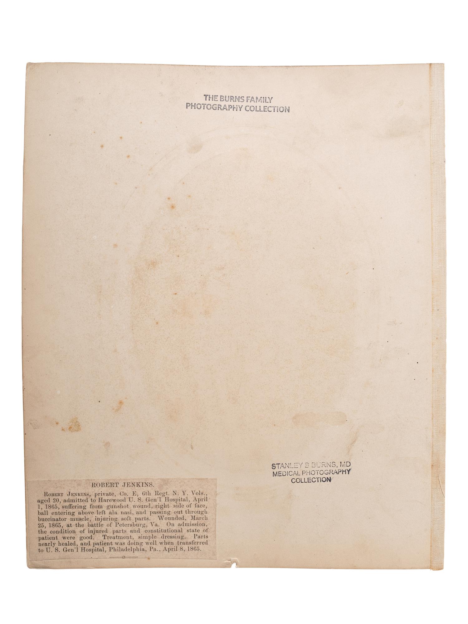 [CIVIL WAR]. Albumen photograph of Private Robert Jenkins, Company E, 6th Regiment, New York Volunteers, wounded Petersburg, Virginia, 25 March 1865, photographed and assembled by Reed Brockway Bontecou, M.D.