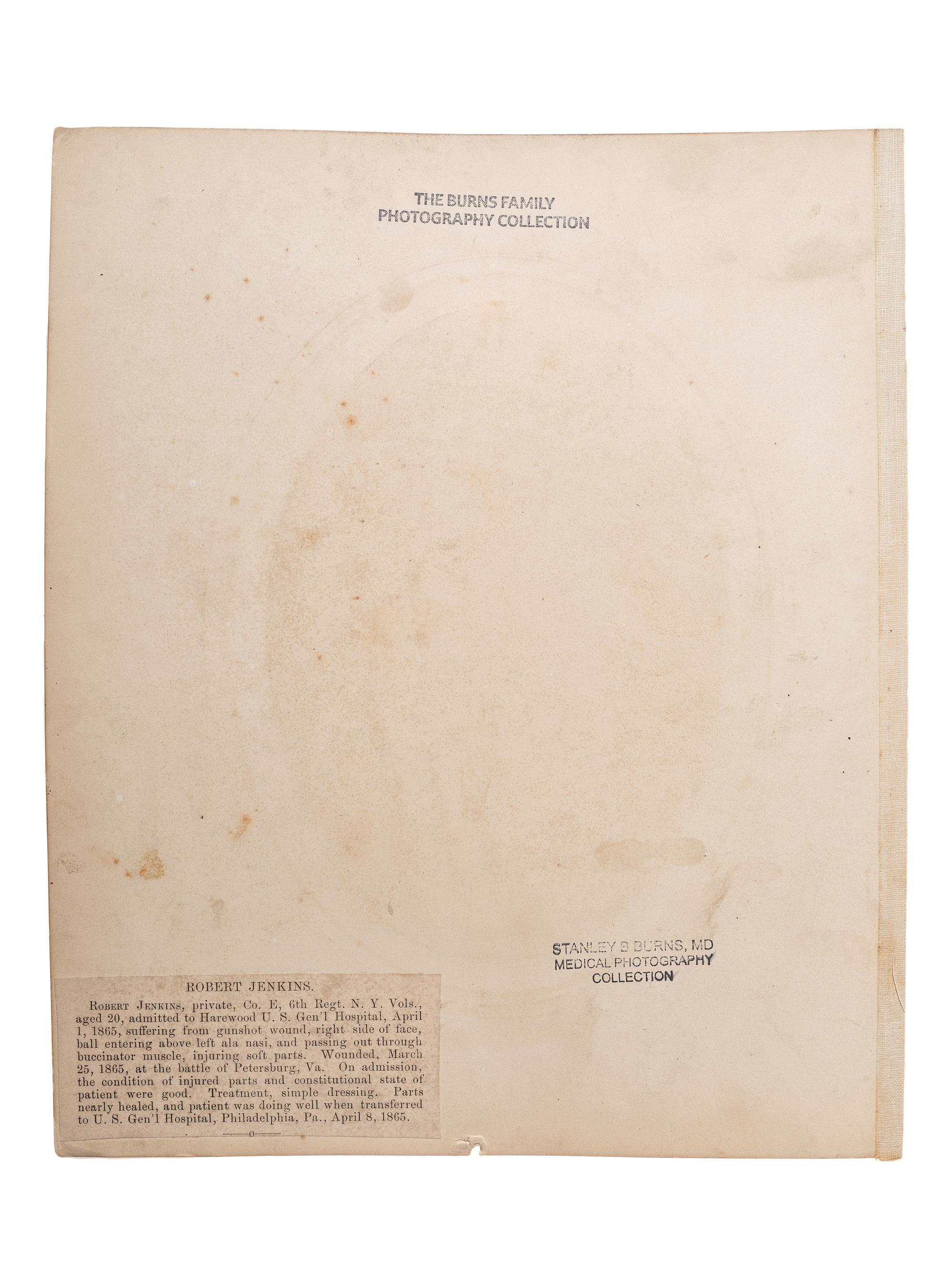 [CIVIL WAR]. Albumen photograph of Private Robert Jenkins, Company E, 6th Regiment, New York Volunteers, wounded Petersburg, Virginia, 25 March 1865, photographed and assembled by Reed Brockway Bontecou, M.D.