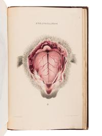 BURROWS, George (1832-1909). On Disorders of the Cerebral Circulation; And on the Connection between Affections of the Brain and Diseases of the Heart. London: Longman, Brown, Green, and Longmans, 1846.