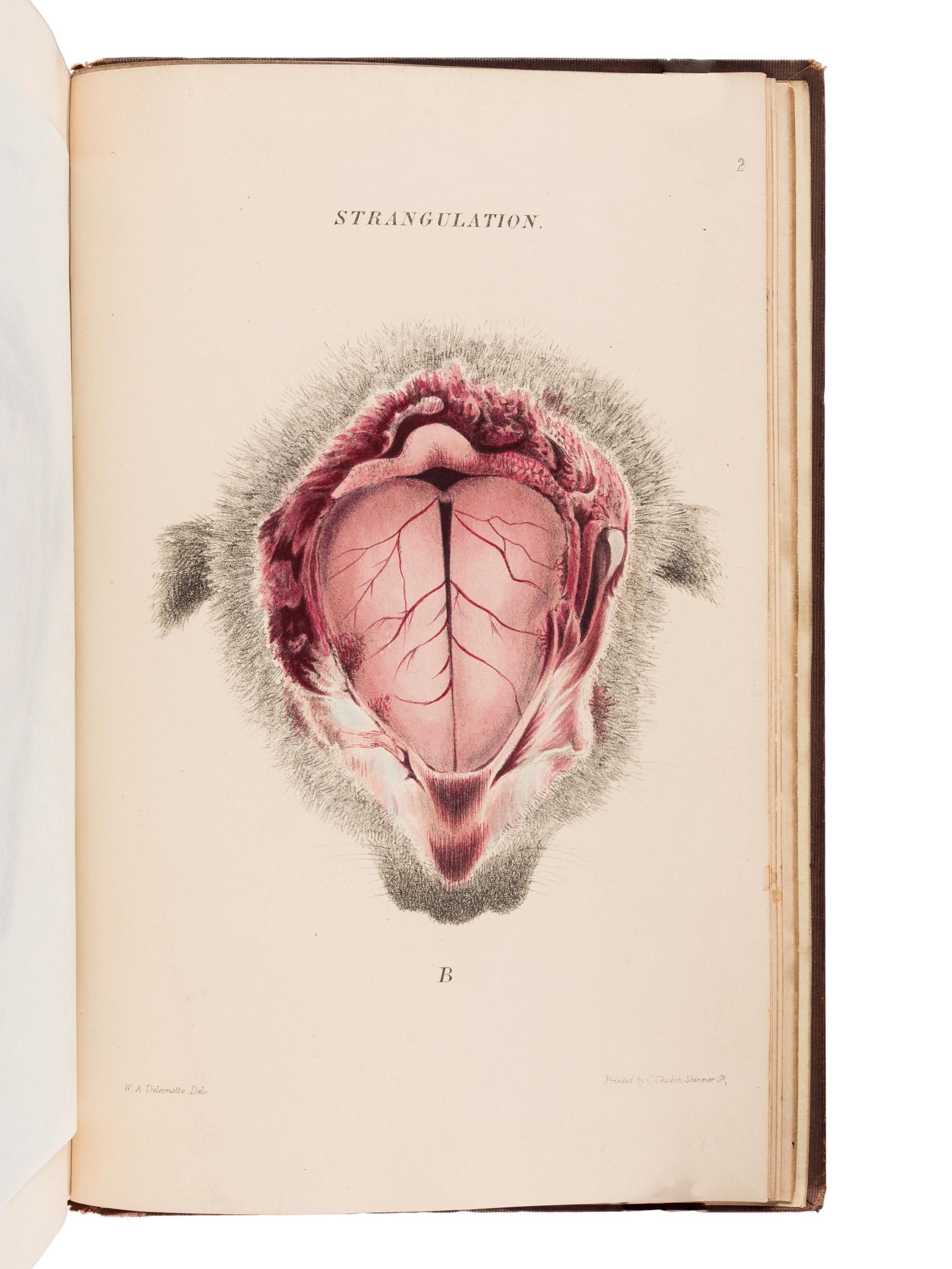 BURROWS, George (1832-1909). On Disorders of the Cerebral Circulation; And on the Connection between Affections of the Brain and Diseases of the Heart. London: Longman, Brown, Green, and Longmans, 1846.