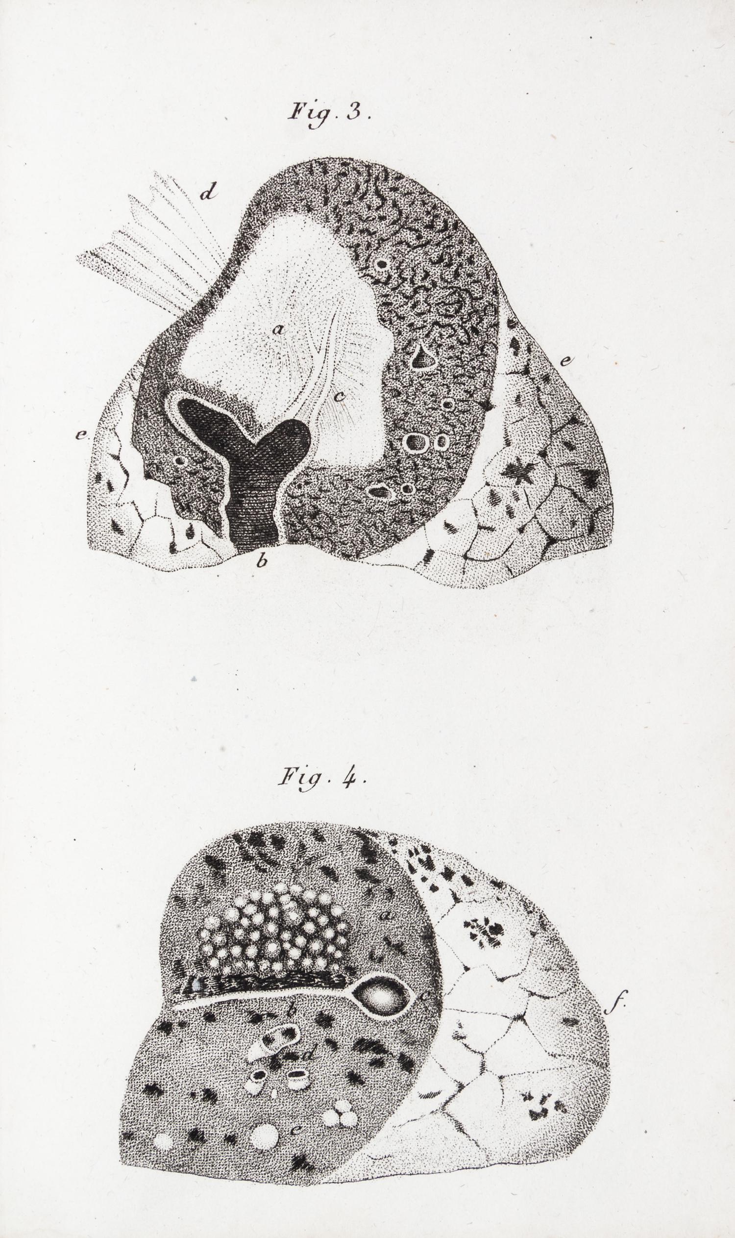 LAENNEC, R.T. Traite de L'Auscultation mediate... Paris, 1826. 2 vols. Second edition.