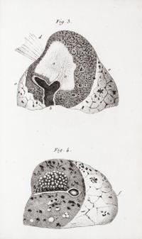 LAENNEC, R.T. Traite de L'Auscultation mediate... Paris, 1826. 2 vols. Second edition.