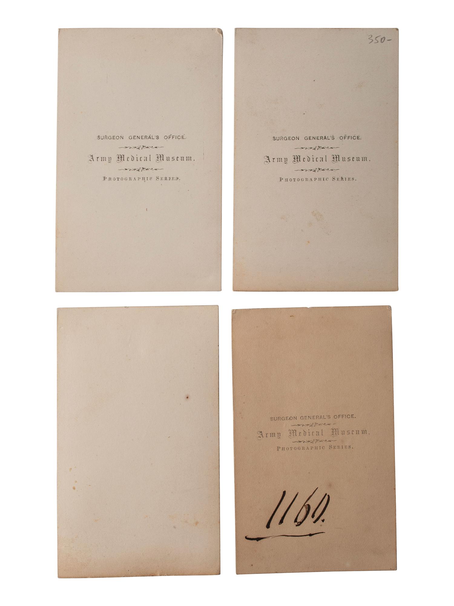 [CIVIL WAR]. A group of 5 CDVs of medical specimens issued by the Surgeon General's Office, Army Medical Museum. [Washington, DC], ca 1860s.