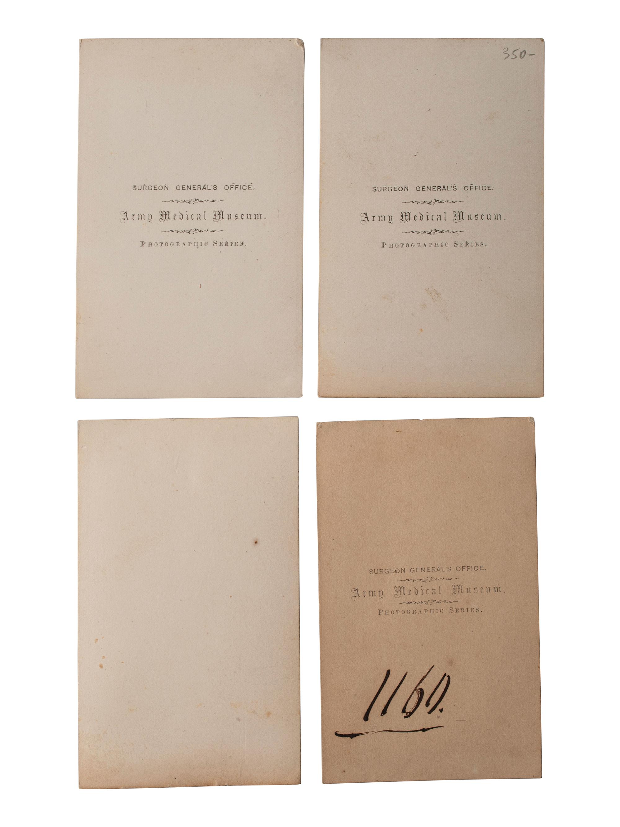[CIVIL WAR]. A group of 5 CDVs of medical specimens issued by the Surgeon General's Office, Army Medical Museum. [Washington, DC], ca 1860s.