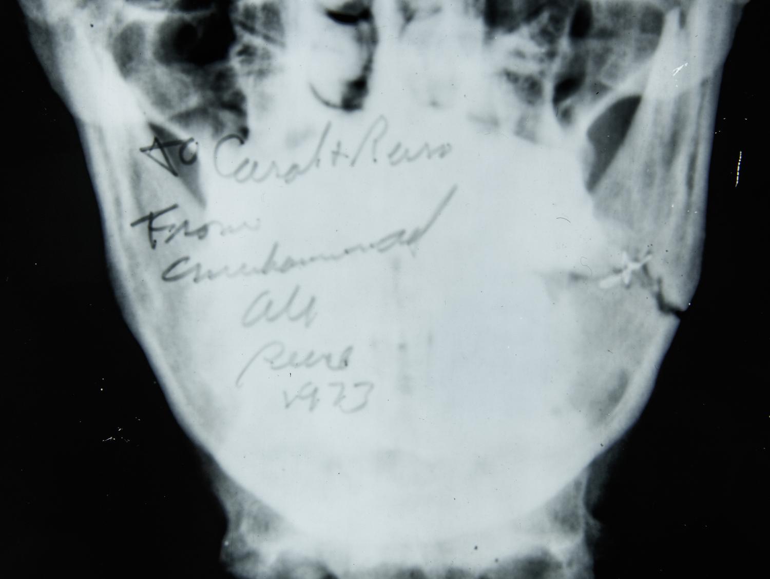 A Muhammad Ali Broken Jaw X-Ray Image From 1973 Ken Norton Fight,