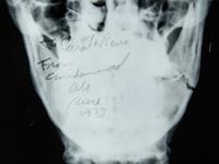 A Muhammad Ali Broken Jaw X-Ray Image From 1973 Ken Norton Fight,