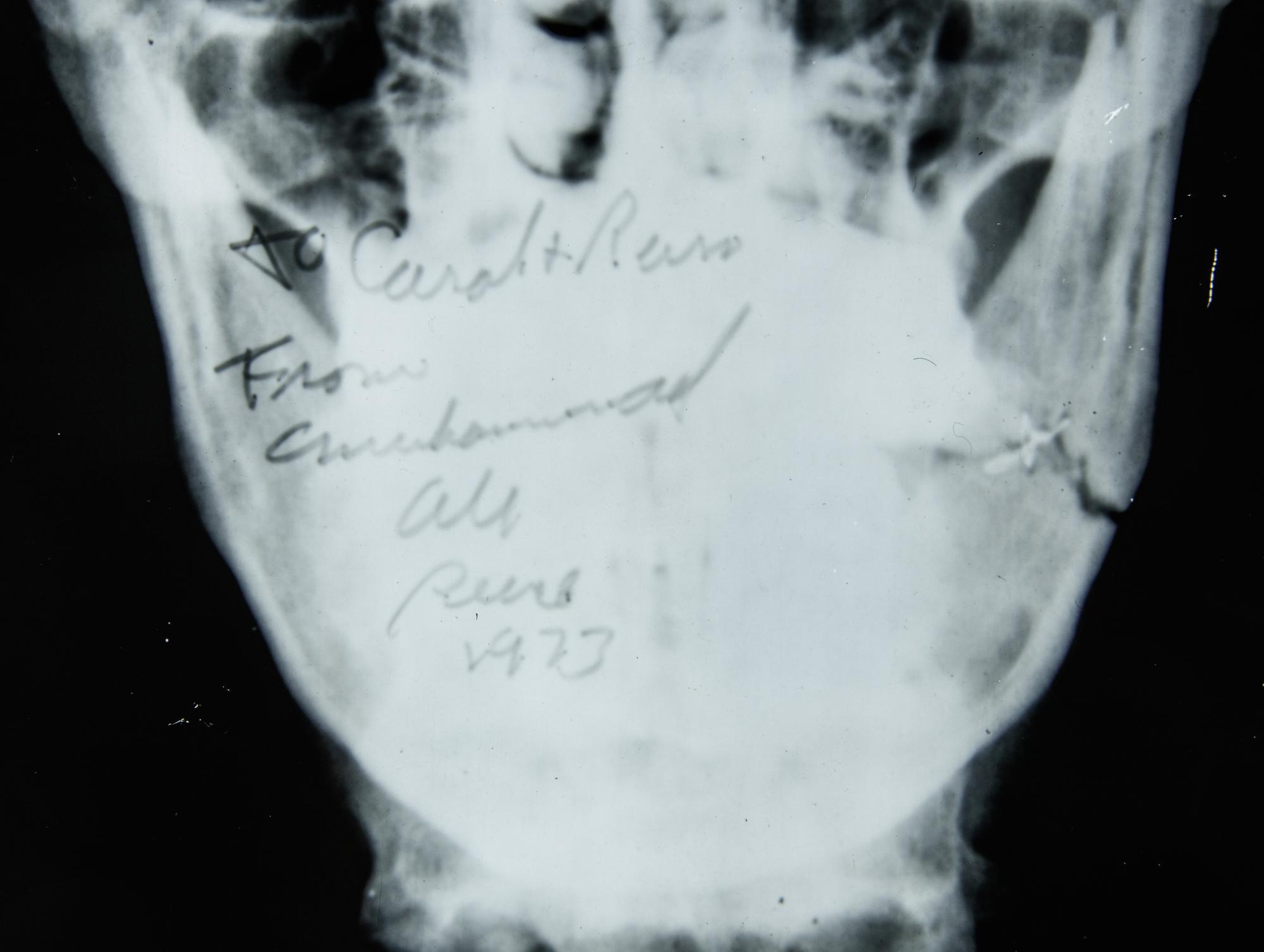 A Muhammad Ali Broken Jaw X-Ray Image From 1973 Ken Norton Fight,
