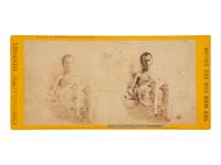 [CIVIL WAR]. Stereoview of Benjamin T. Daugherty, an Andersonville prisoner. New York: E. & H. T. Anthony & Co., 1865.