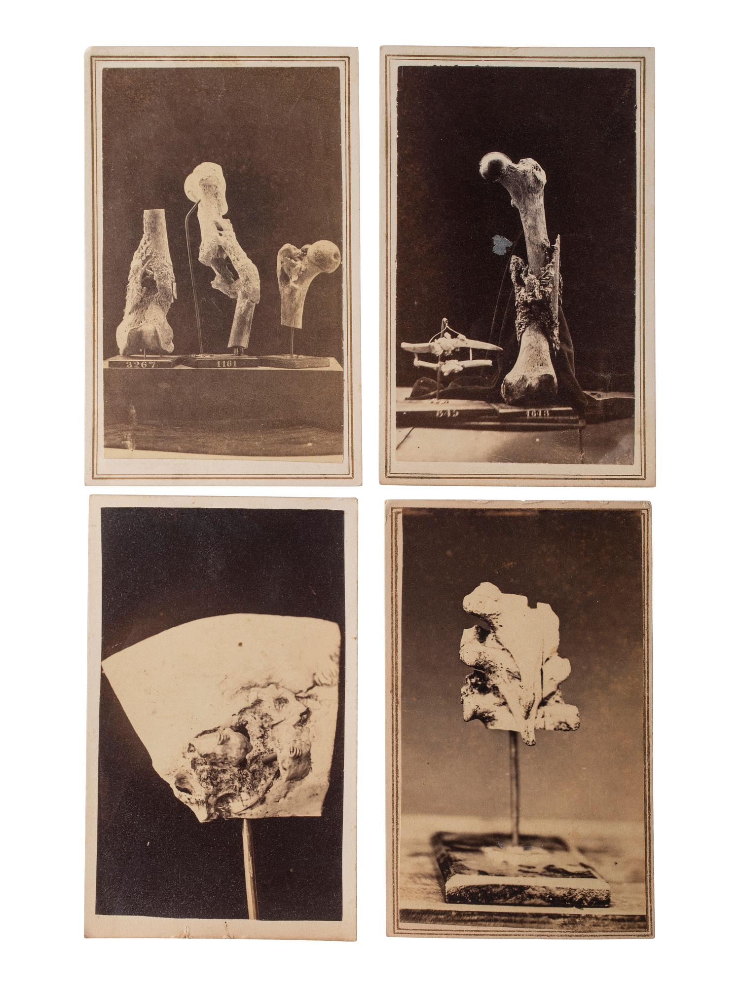 [CIVIL WAR]. A group of 5 CDVs of medical specimens issued by the Surgeon General's Office, Army Medical Museum. [Washington, DC], ca 1860s.