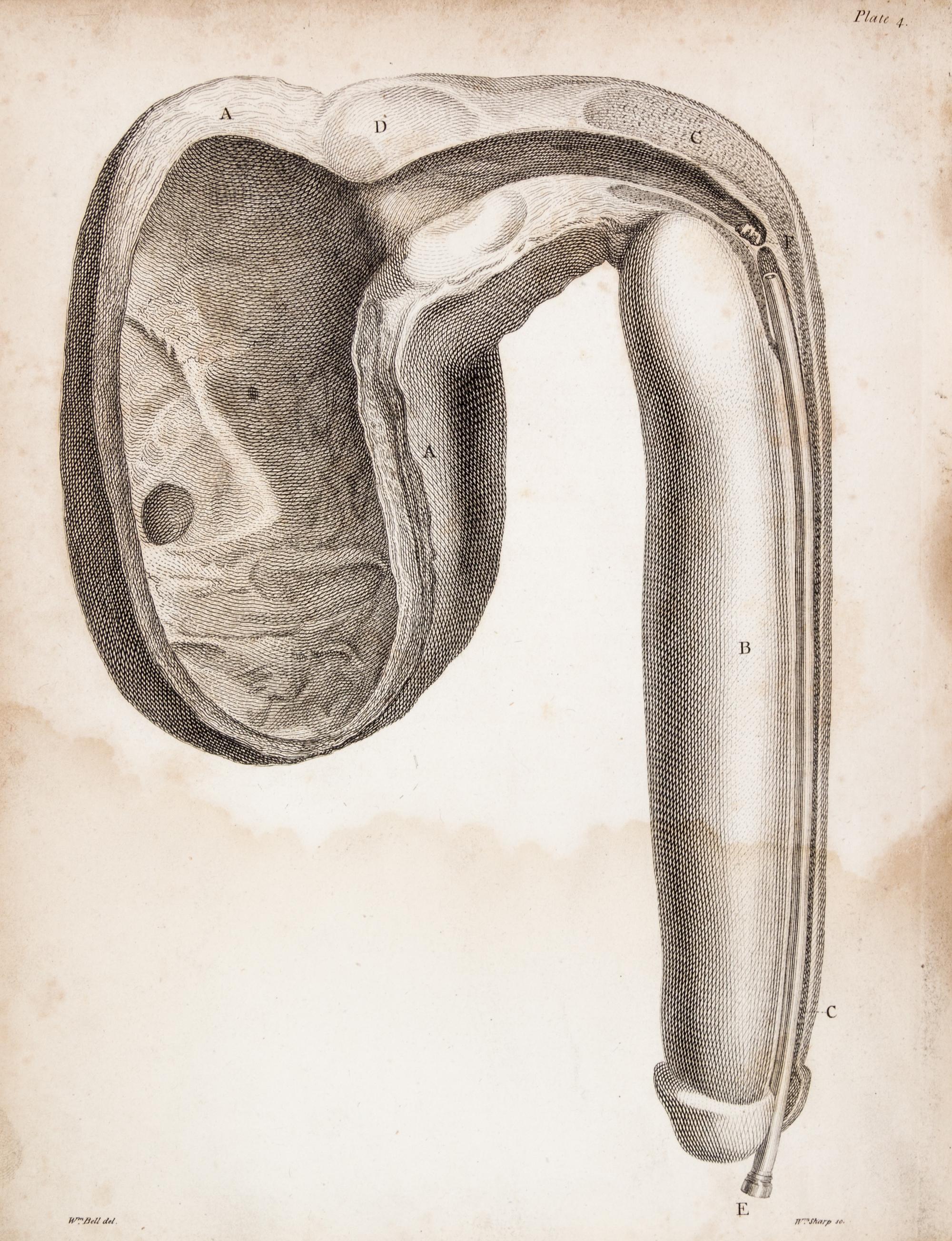 HUNTER, JOHN. A Treatise on the Venereal Disease. London, 1786. First edition.