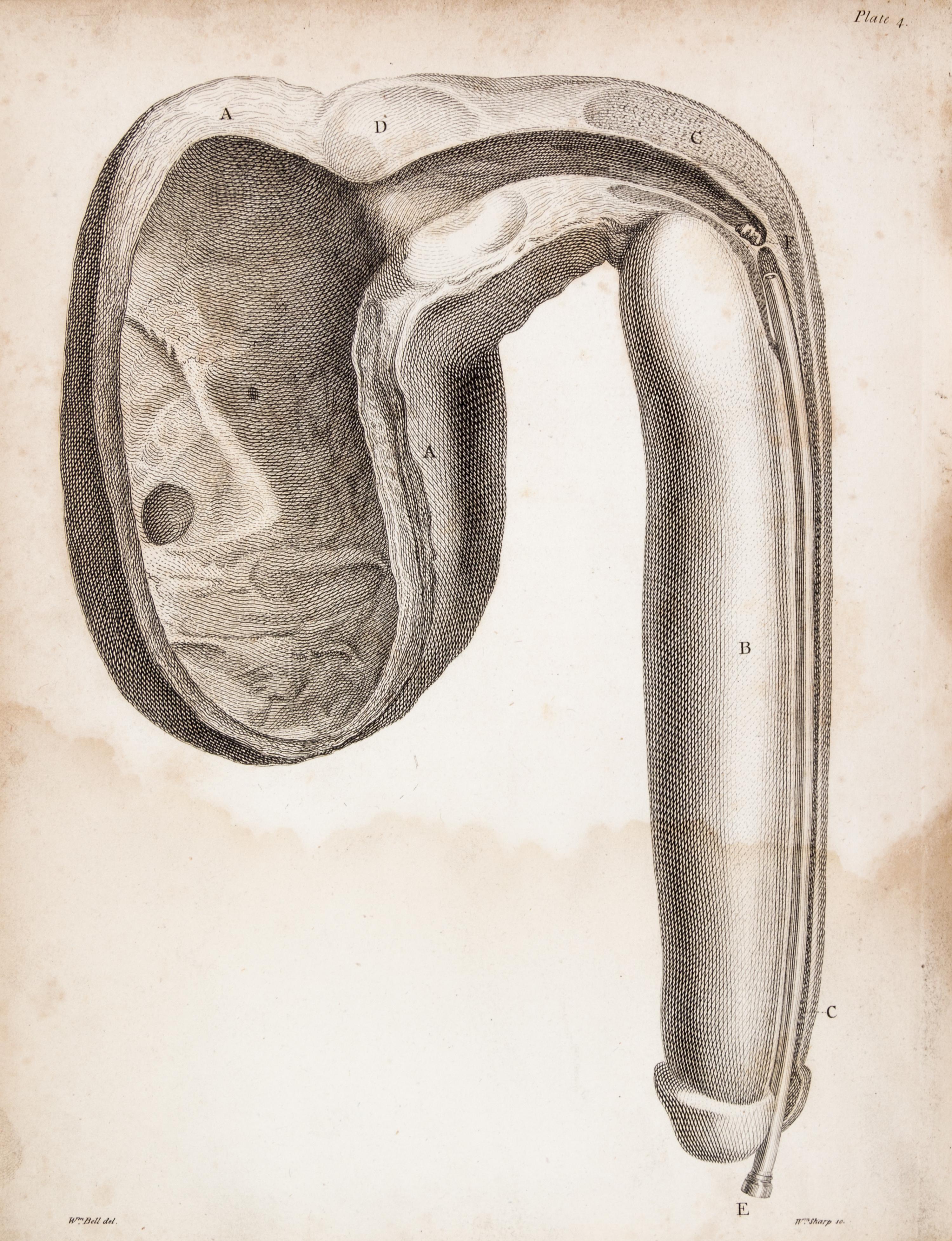 HUNTER, JOHN. A Treatise on the Venereal Disease. London, 1786. First edition.