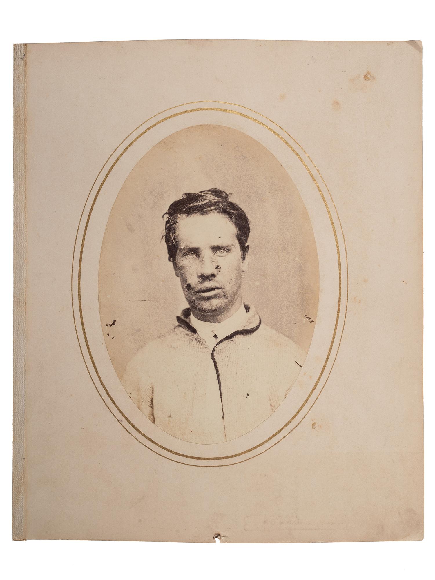 [CIVIL WAR]. Albumen photograph of Private Robert Jenkins, Company E, 6th Regiment, New York Volunteers, wounded Petersburg, Virginia, 25 March 1865, photographed and assembled by Reed Brockway Bontecou, M.D.