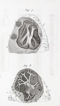 LAENNEC, R.T. Traite de L'Auscultation mediate... Paris, 1826. 2 vols. Second edition.
