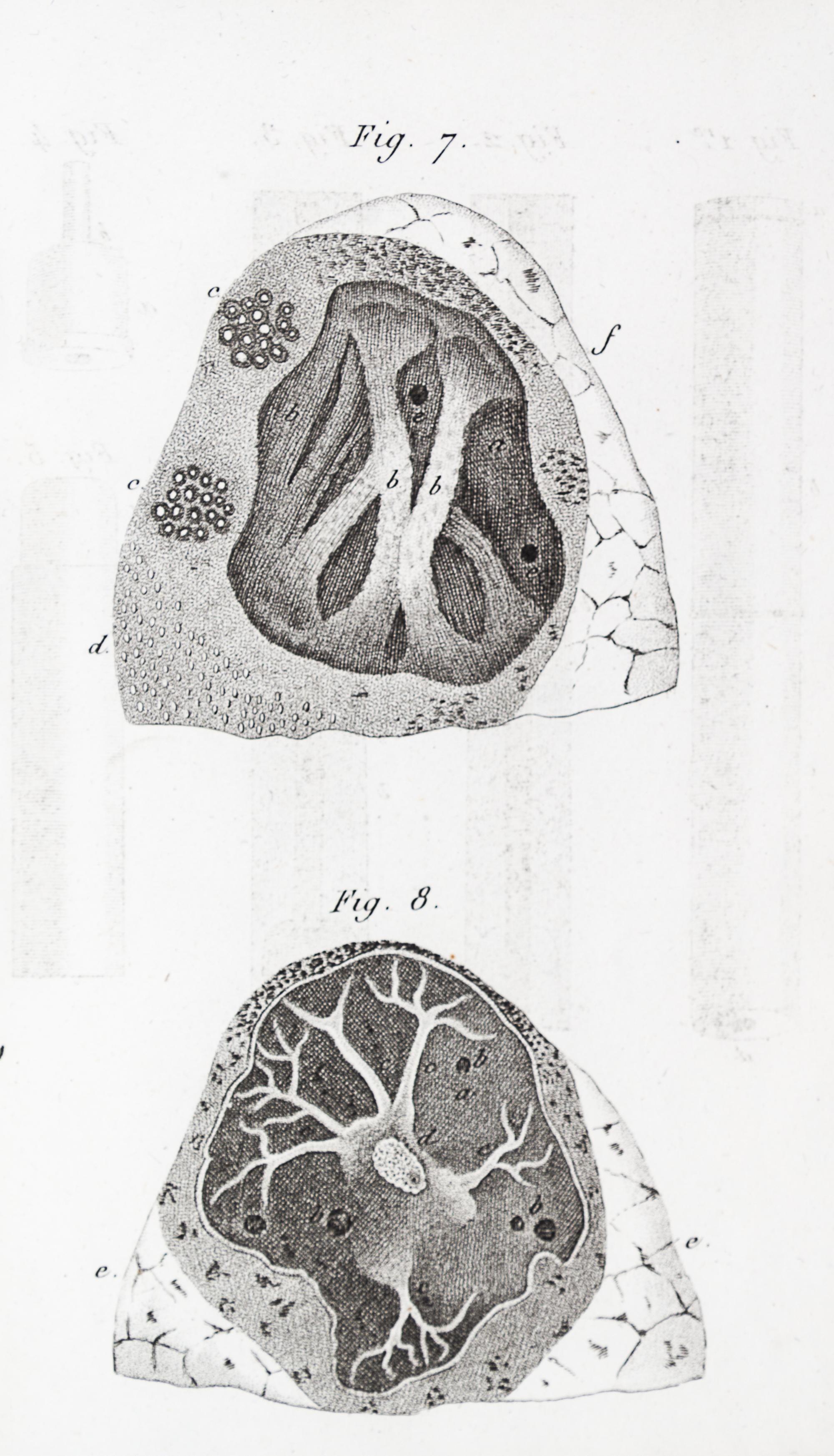 LAENNEC, R.T. Traite de L'Auscultation mediate... Paris, 1826. 2 vols. Second edition.