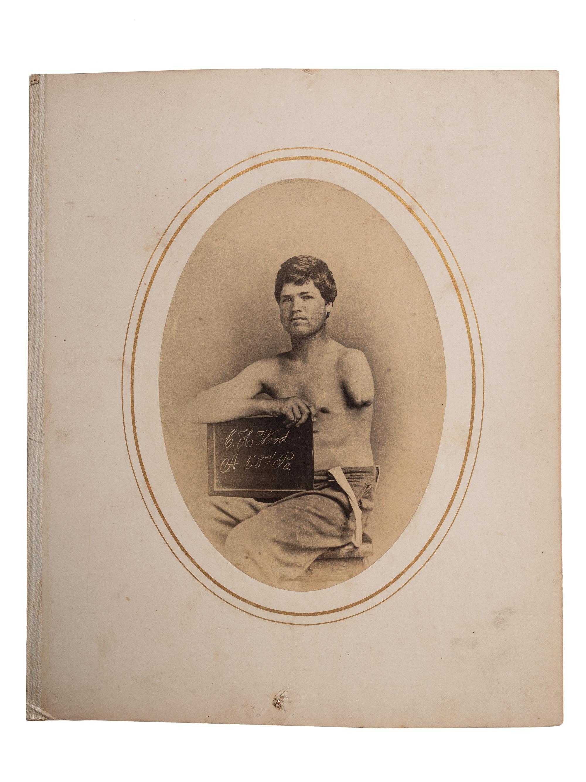 [CIVIL WAR]. Albumen photograph of Private Charles H. Wood, Company D, 53rd Regiment, Pennsylvania Volunteers, wounded Petersburg, Virginia, 31 March 1865, photographed and assembled by Reed Brockway Bontecou, M.D.