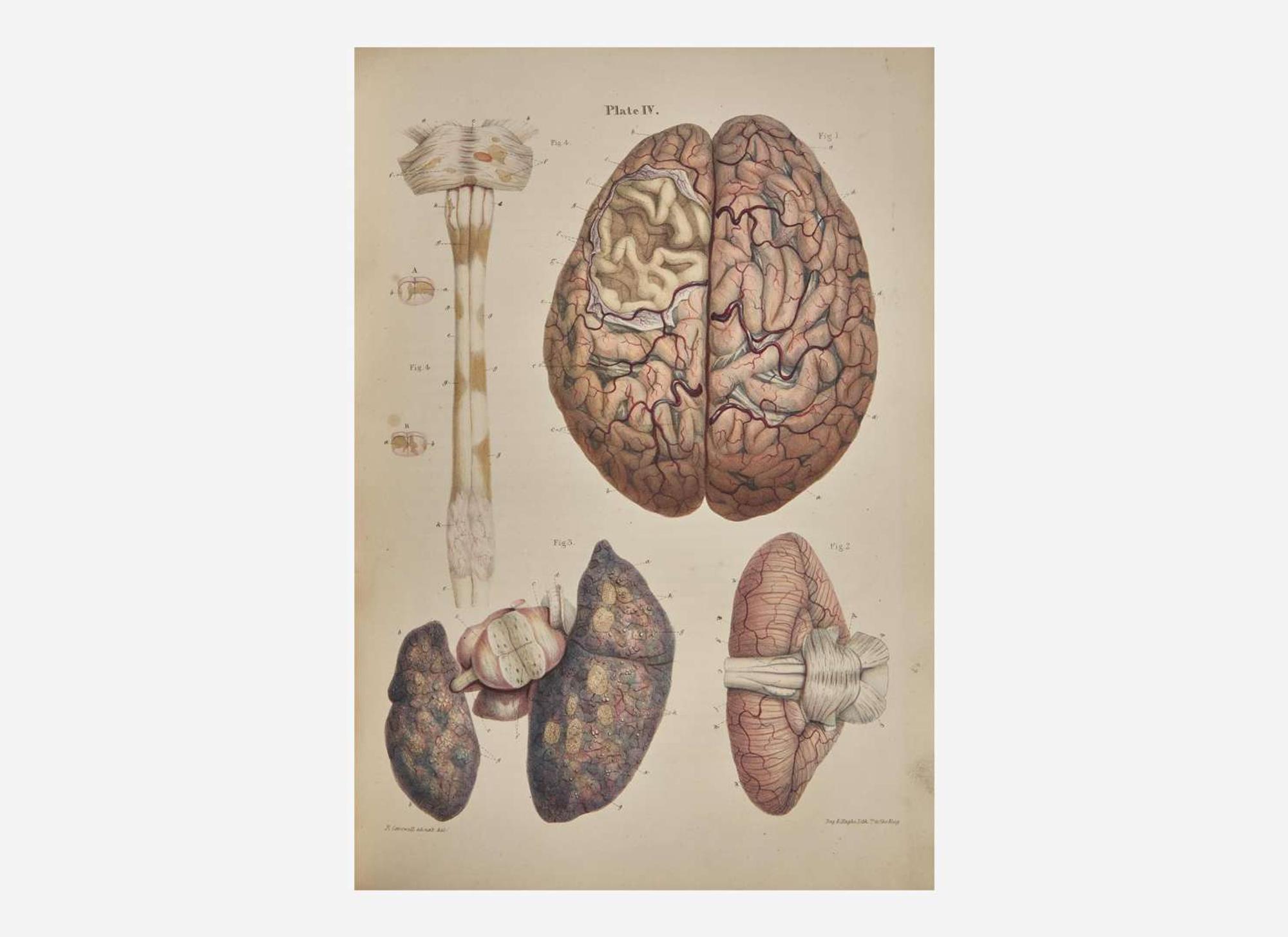 [Science, Medicine & Mathematics] Carswell, Robert: Pathological Anatomy. Illustrations of the Elementary Forms of Disease