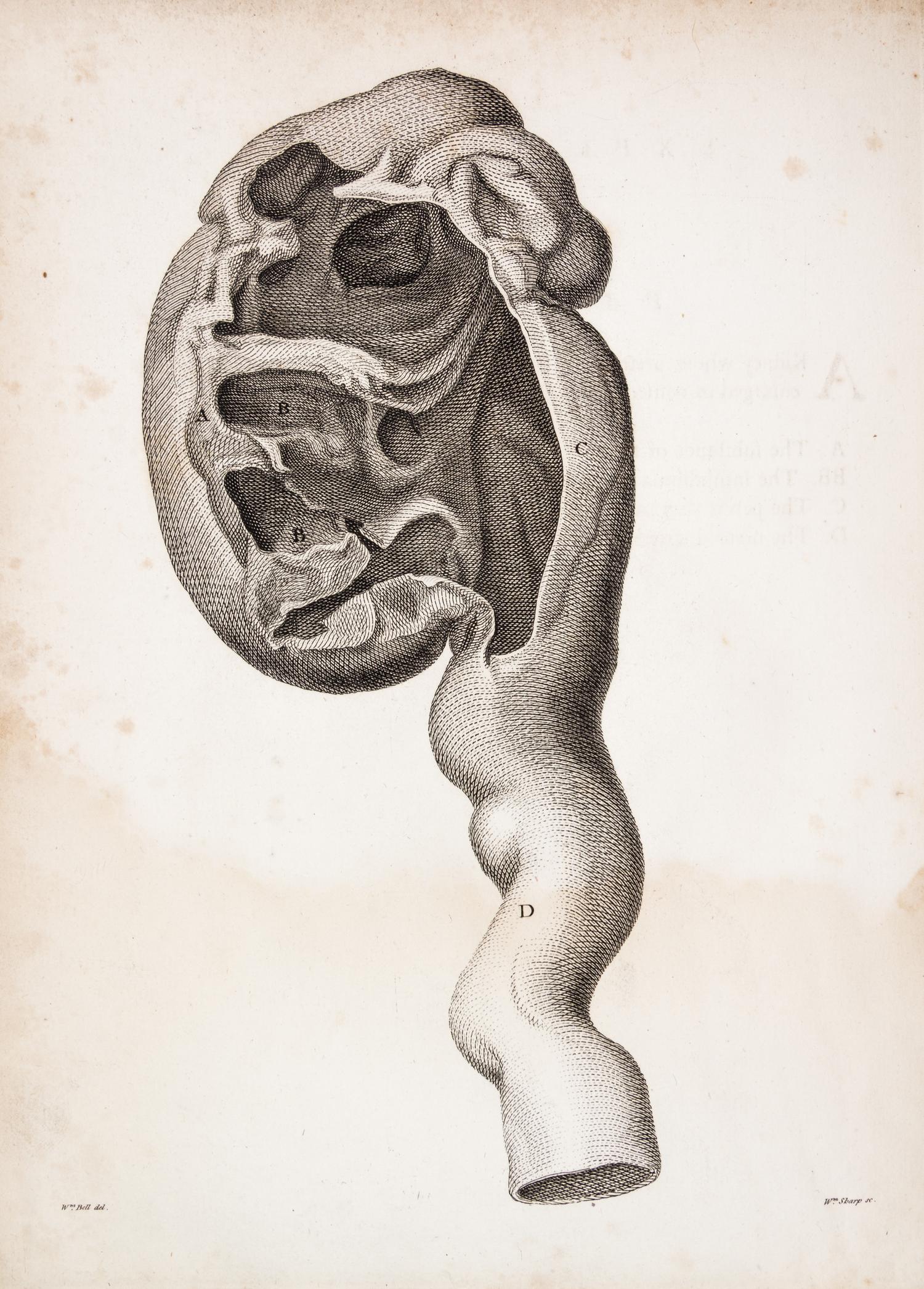 HUNTER, JOHN. A Treatise on the Venereal Disease. London, 1786. First edition.