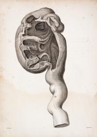 HUNTER, JOHN. A Treatise on the Venereal Disease. London, 1786. First edition.
