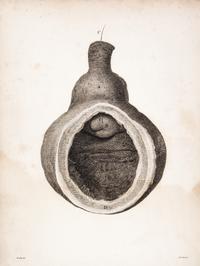 HUNTER, JOHN. A Treatise on the Venereal Disease. London, 1786. First edition.