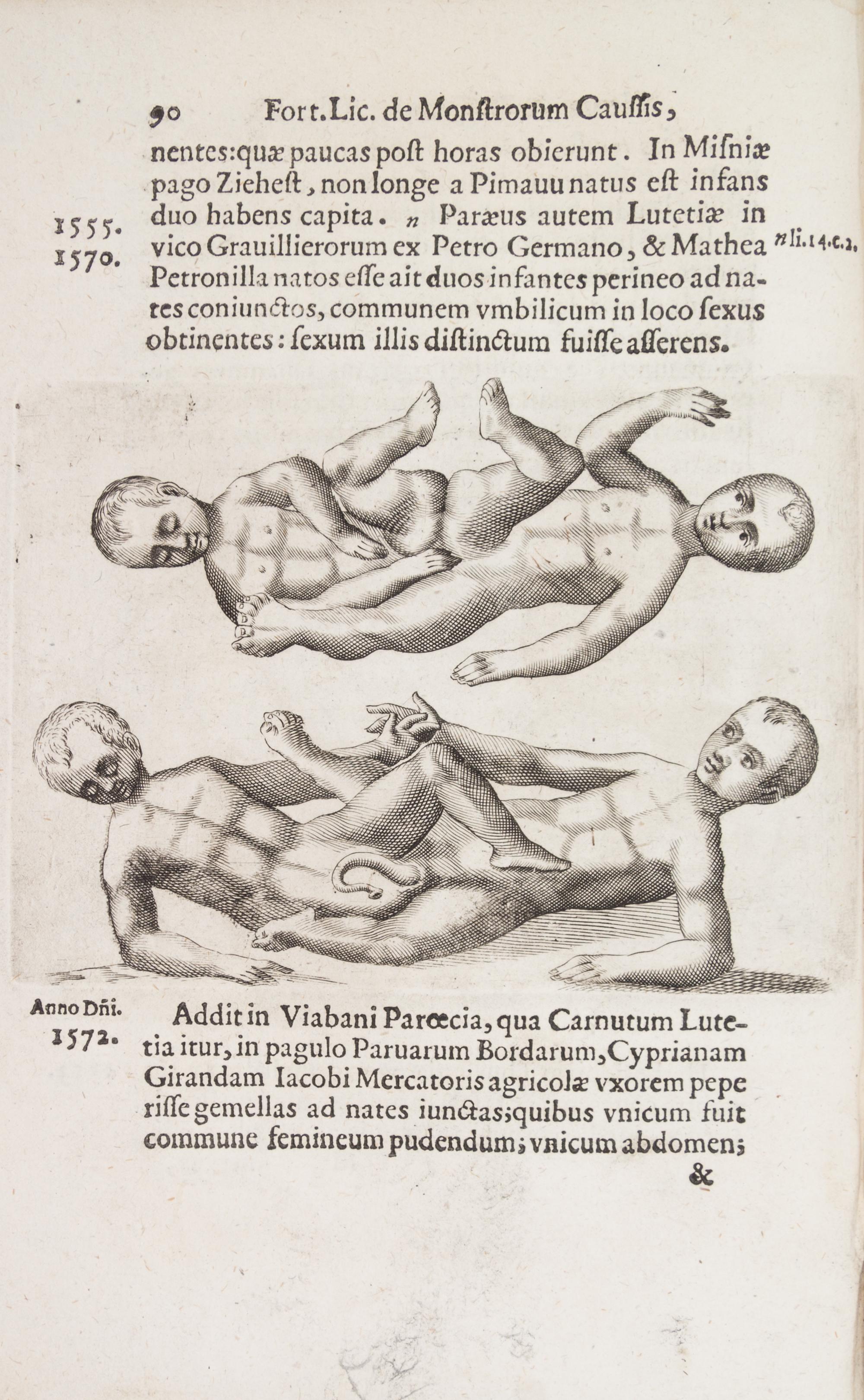 LICETUS, FORTUNIS. De monstrorum natura... Padua, 1634. First illustrated ed. of a work on "monsters" or physical deformities.