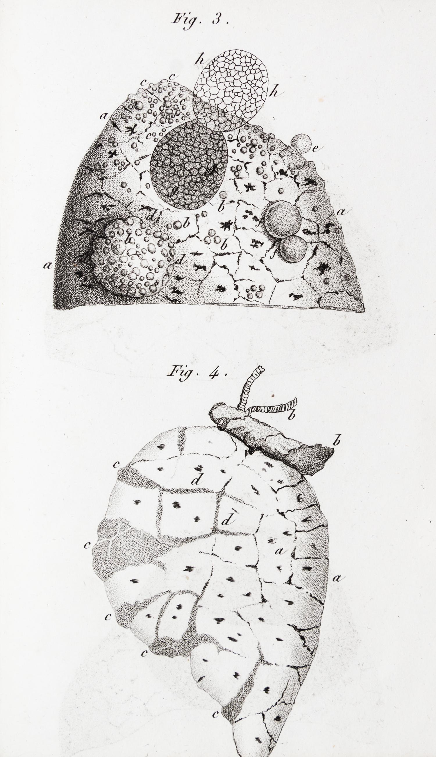 LAENNEC, R.T. Traite de L'Auscultation mediate... Paris, 1826. 2 vols. Second edition.