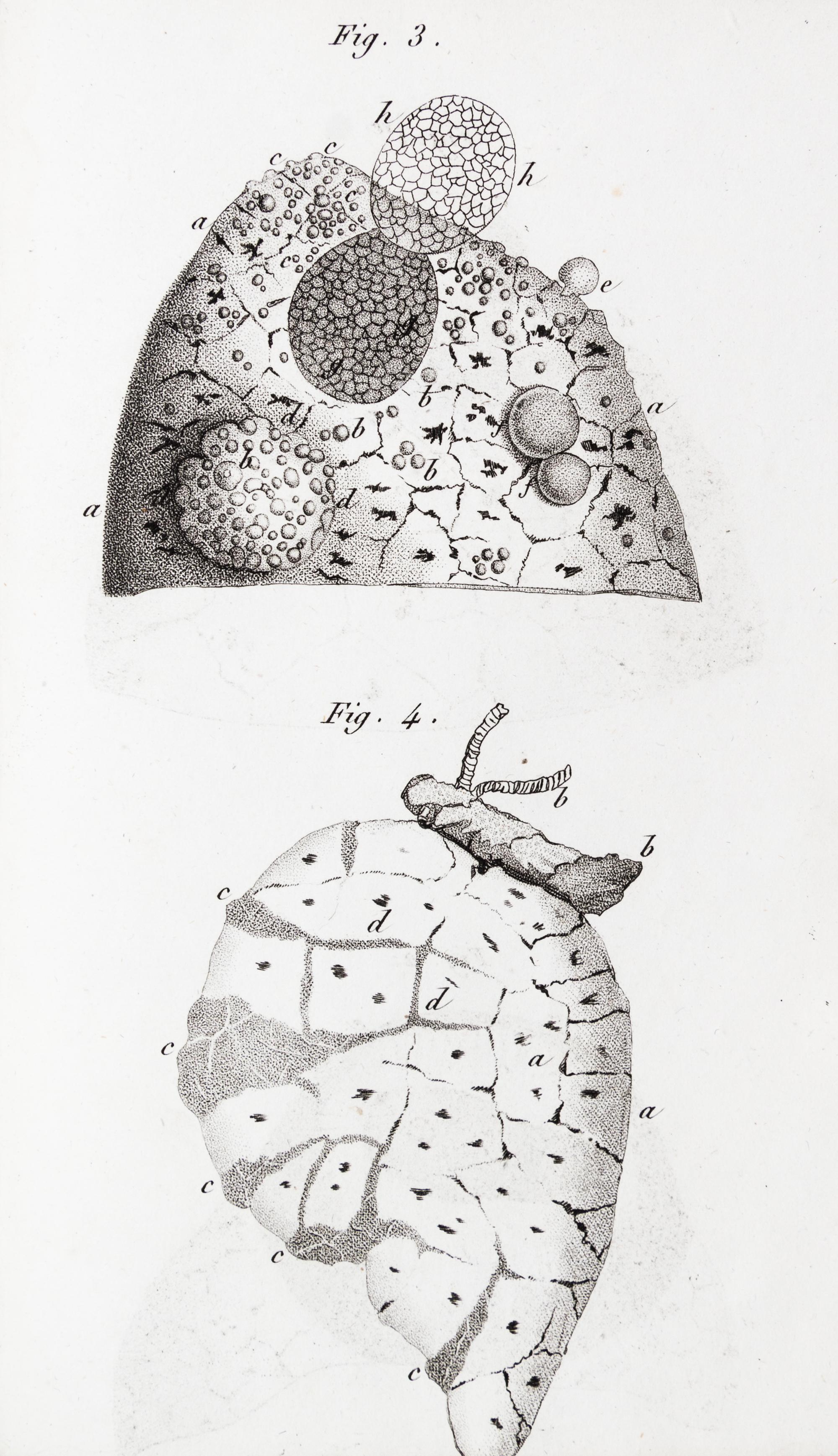 LAENNEC, R.T. Traite de L'Auscultation mediate... Paris, 1826. 2 vols. Second edition.