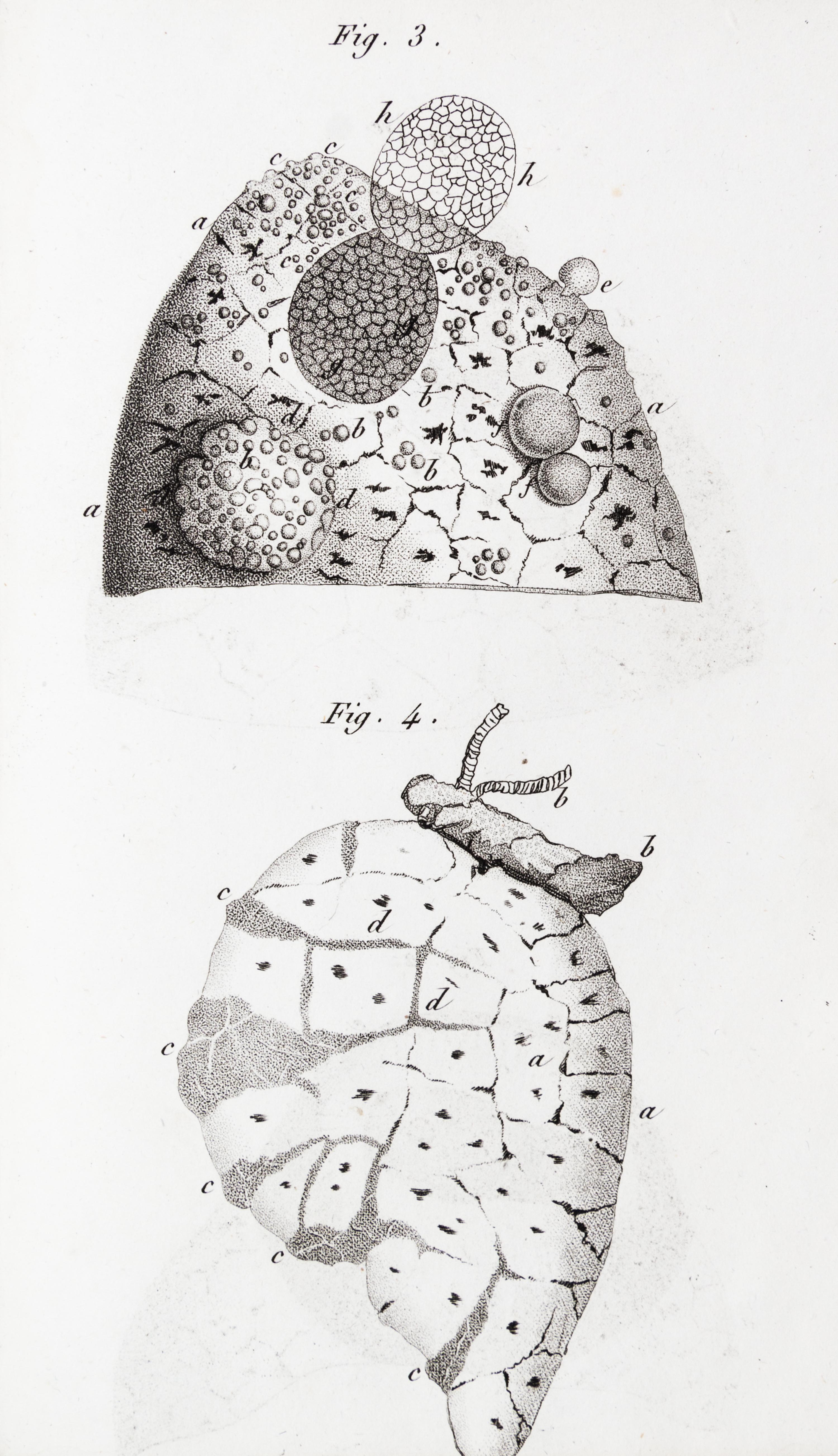 LAENNEC, R.T. Traite de L'Auscultation mediate... Paris, 1826. 2 vols. Second edition.