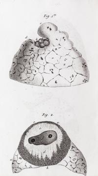 LAENNEC, R.T. Traite de L'Auscultation mediate... Paris, 1826. 2 vols. Second edition.