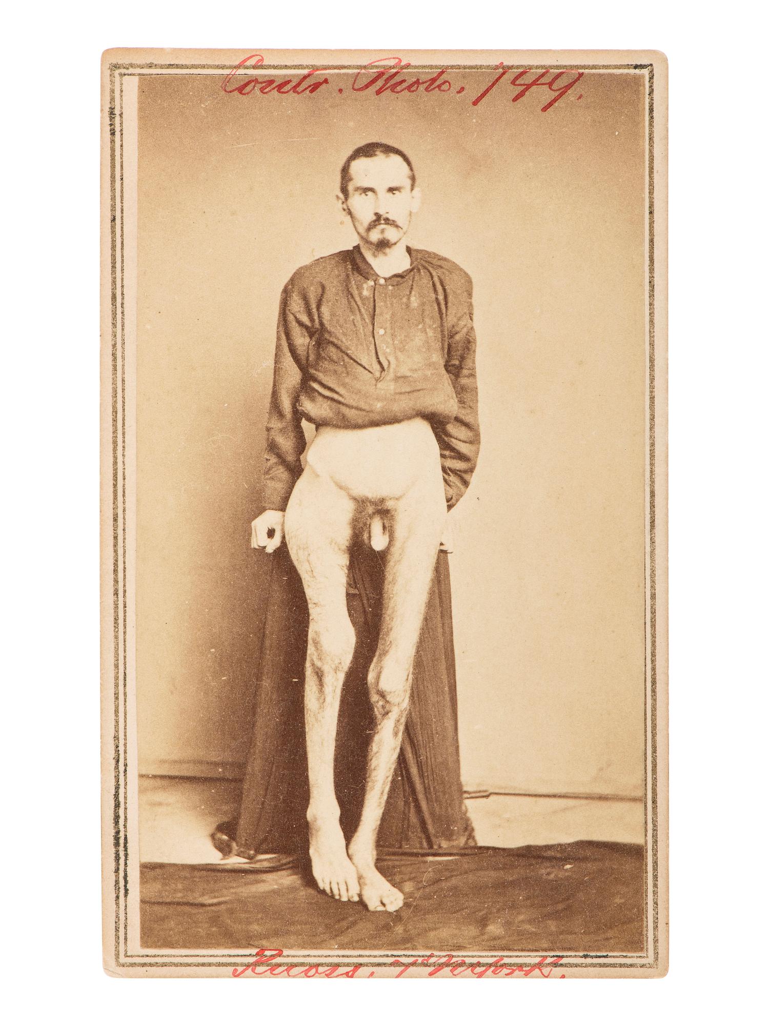 [CIVIL WAR]. [BELL, William H., photographer]. CDV of a wounded soldier identified as Private George Ruoss, 7th New York Veteran Infantry, featured naked below the waist.