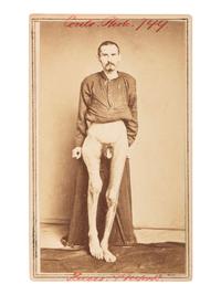 [CIVIL WAR]. [BELL, William H., photographer]. CDV of a wounded soldier identified as Private George Ruoss, 7th New York Veteran Infantry, featured naked below the waist.