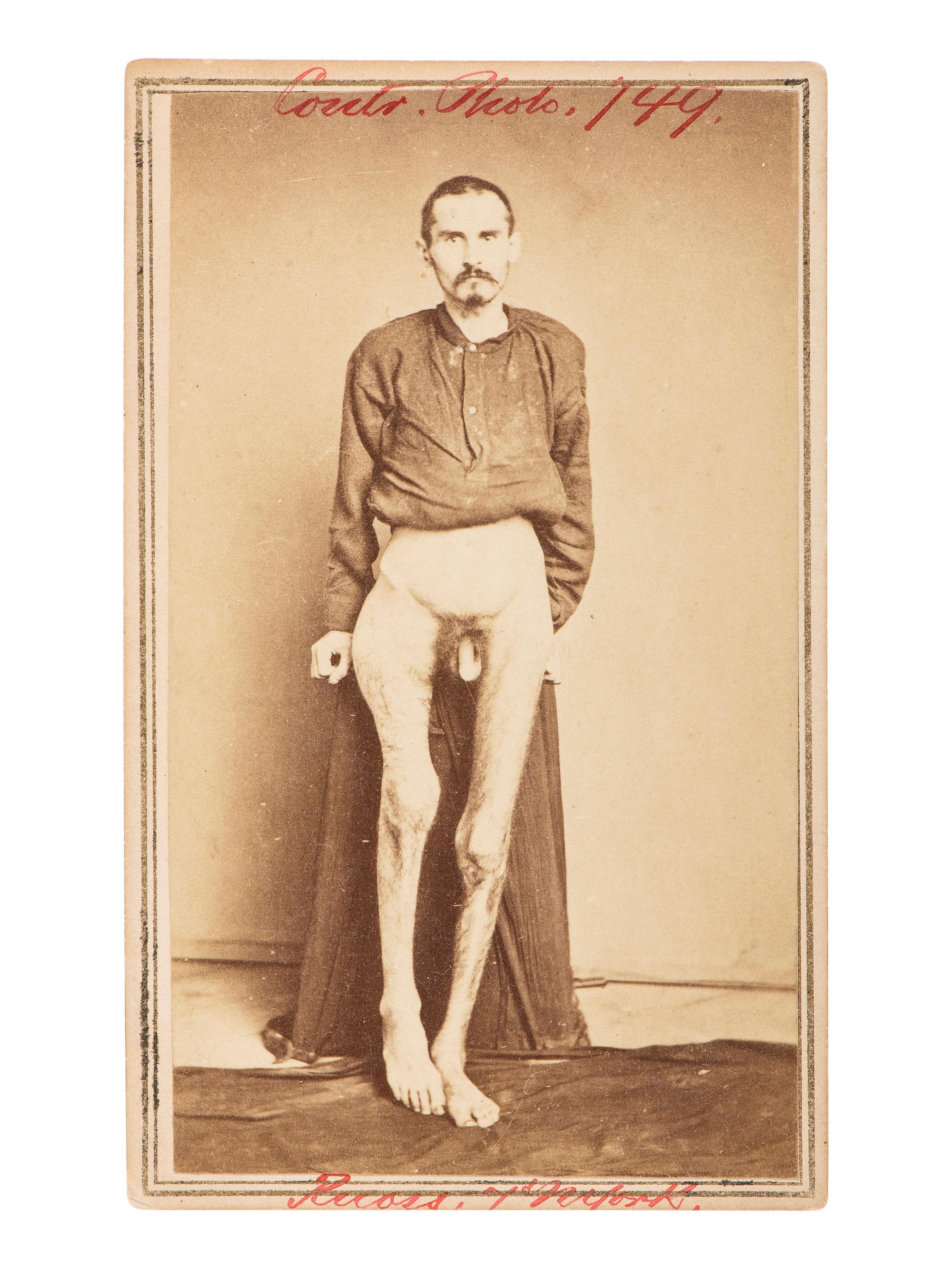 [CIVIL WAR]. [BELL, William H., photographer]. CDV of a wounded soldier identified as Private George Ruoss, 7th New York Veteran Infantry, featured naked below the waist.