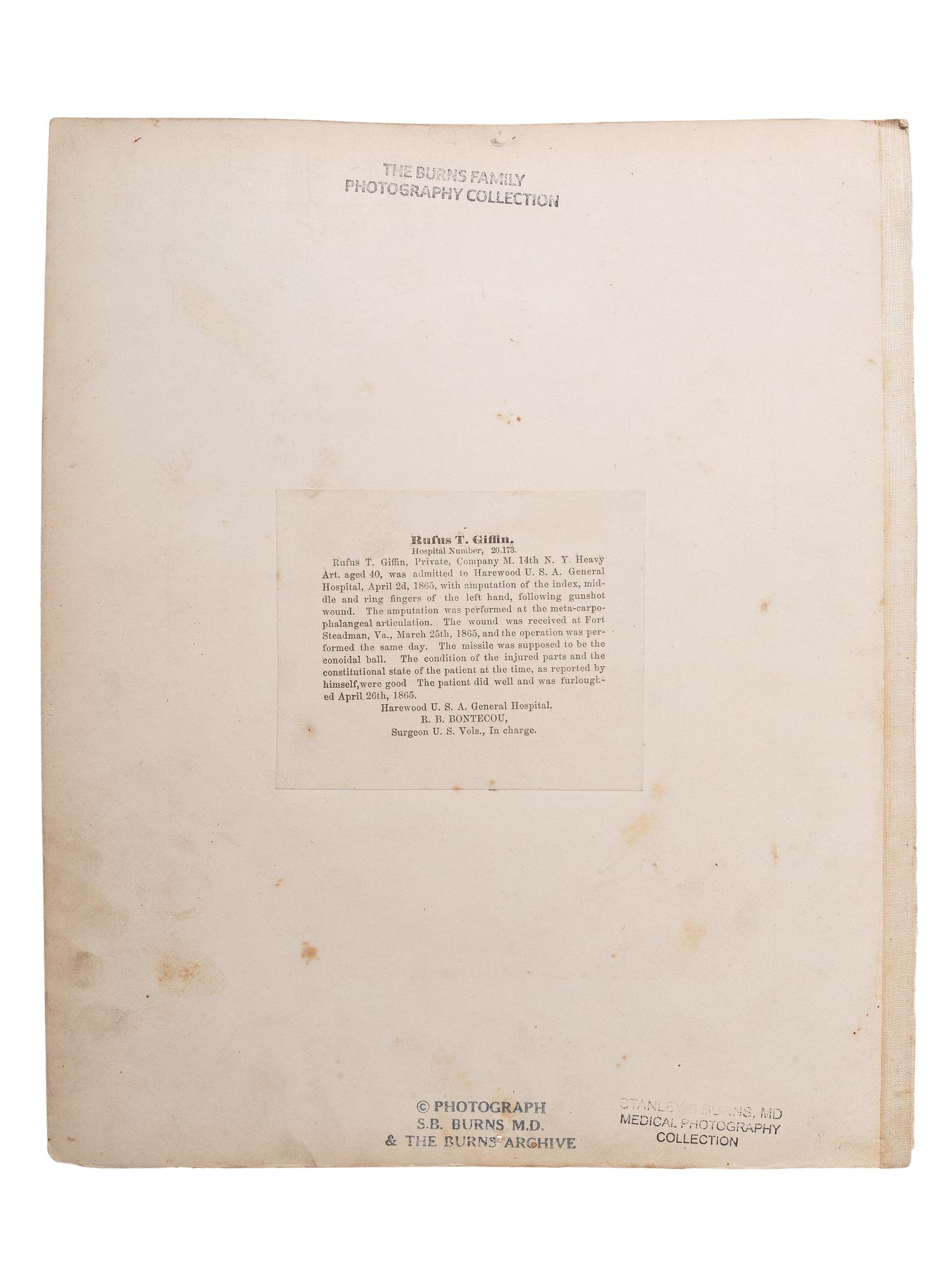 [CIVIL WAR]. Albumen photograph of Private Rufus T. Giffin, Company M, 14th Regiment New York, Heavy Artillery, wounded Fort Steadman, Virginia, 25 March 1865, infection of left hand, photographed and assembled by Reed Brockway Bontecou, M.D.