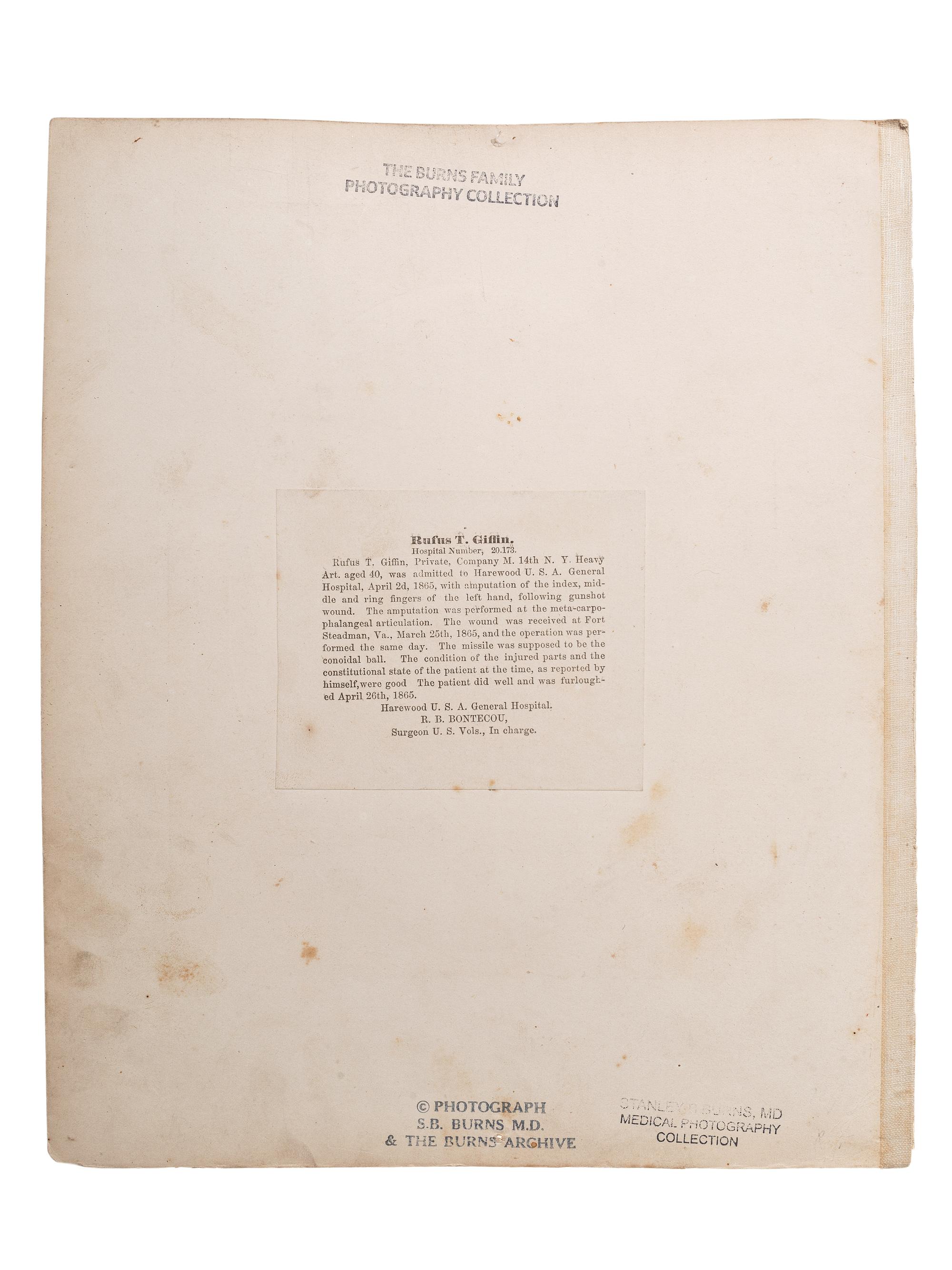 [CIVIL WAR]. Albumen photograph of Private Rufus T. Giffin, Company M, 14th Regiment New York, Heavy Artillery, wounded Fort Steadman, Virginia, 25 March 1865, infection of left hand, photographed and assembled by Reed Brockway Bontecou, M.D.
