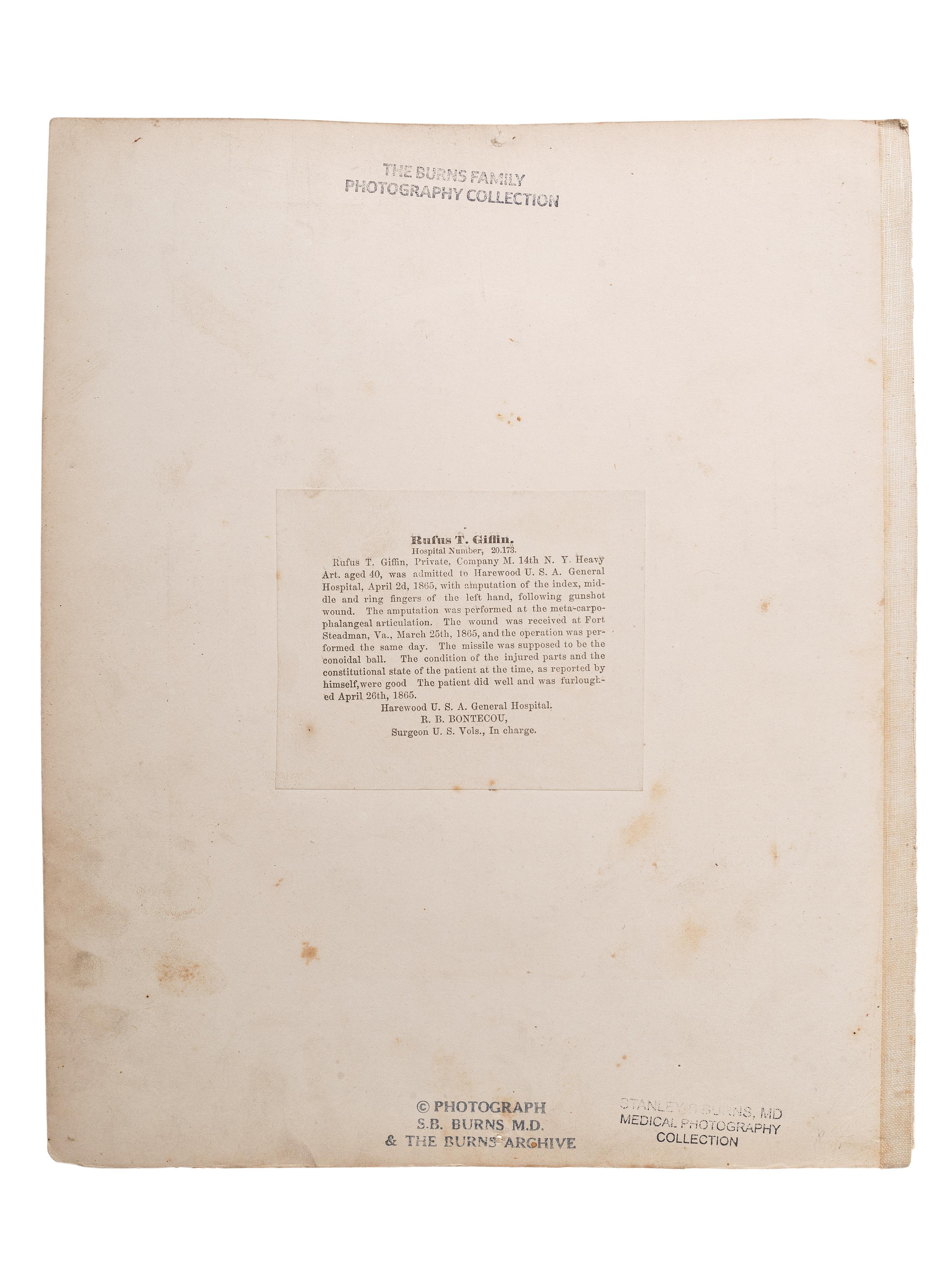 [CIVIL WAR]. Albumen photograph of Private Rufus T. Giffin, Company M, 14th Regiment New York, Heavy Artillery, wounded Fort Steadman, Virginia, 25 March 1865, infection of left hand, photographed and assembled by Reed Brockway Bontecou, M.D.