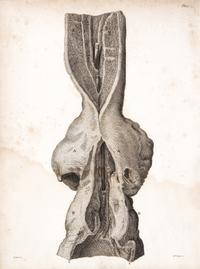 HUNTER, JOHN. A Treatise on the Venereal Disease. London, 1786. First edition.