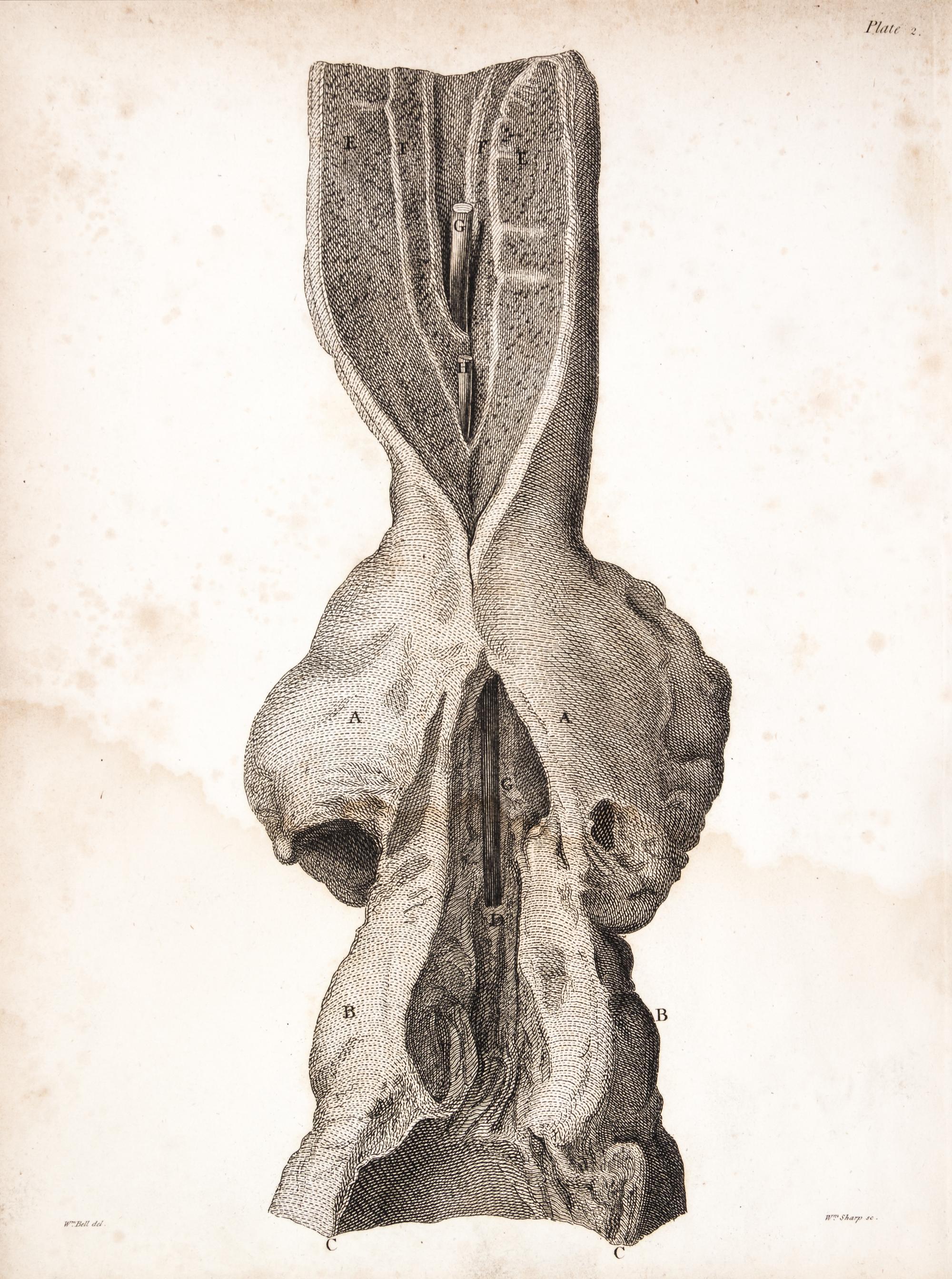 HUNTER, JOHN. A Treatise on the Venereal Disease. London, 1786. First edition.