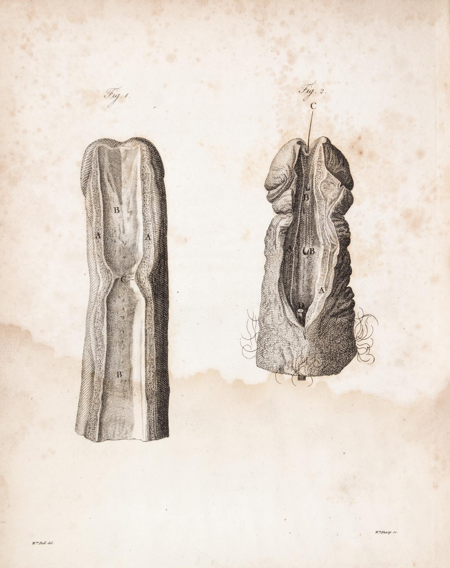 HUNTER, JOHN. A Treatise on the Venereal Disease. London, 1786. First edition.