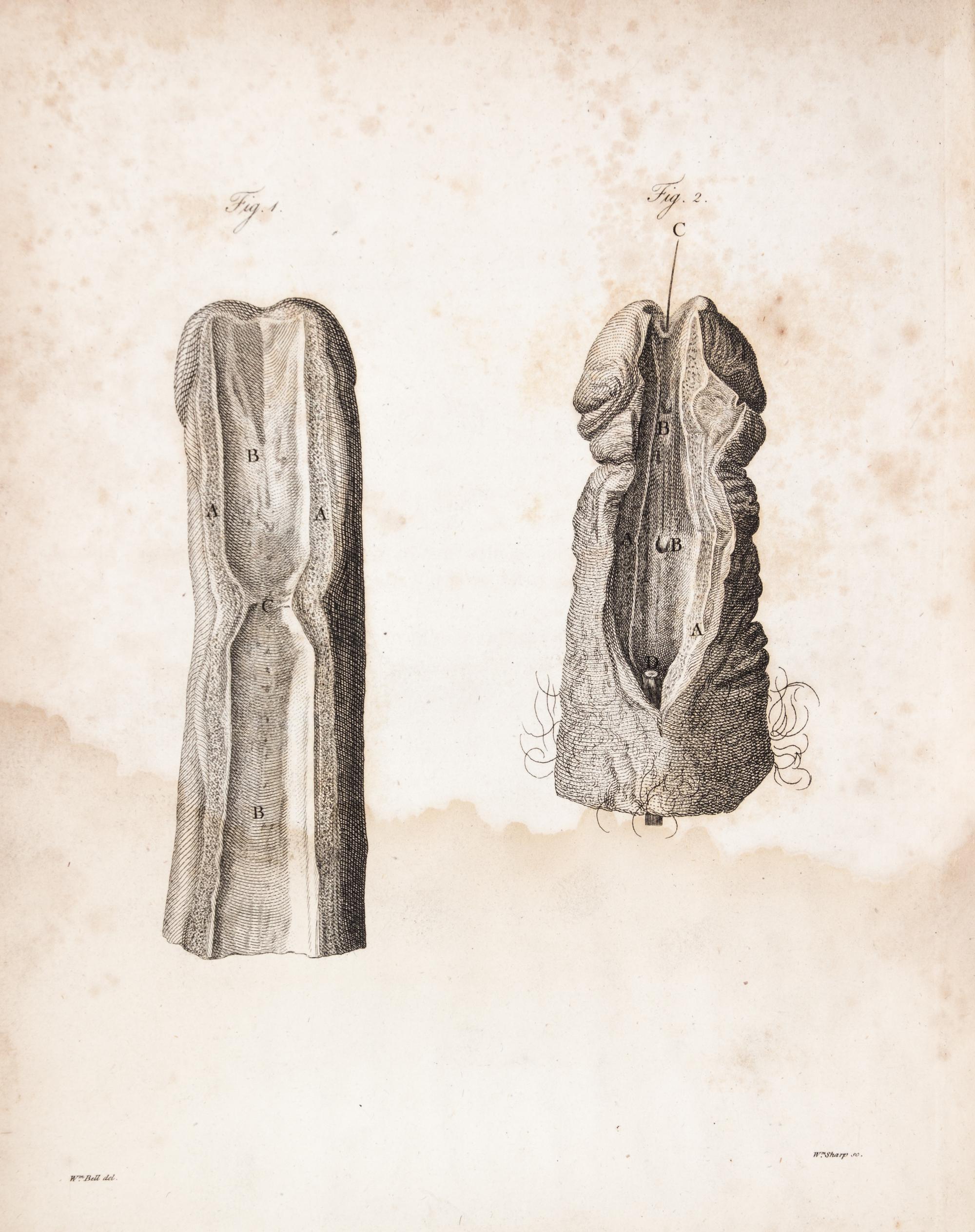 HUNTER, JOHN. A Treatise on the Venereal Disease. London, 1786. First edition.