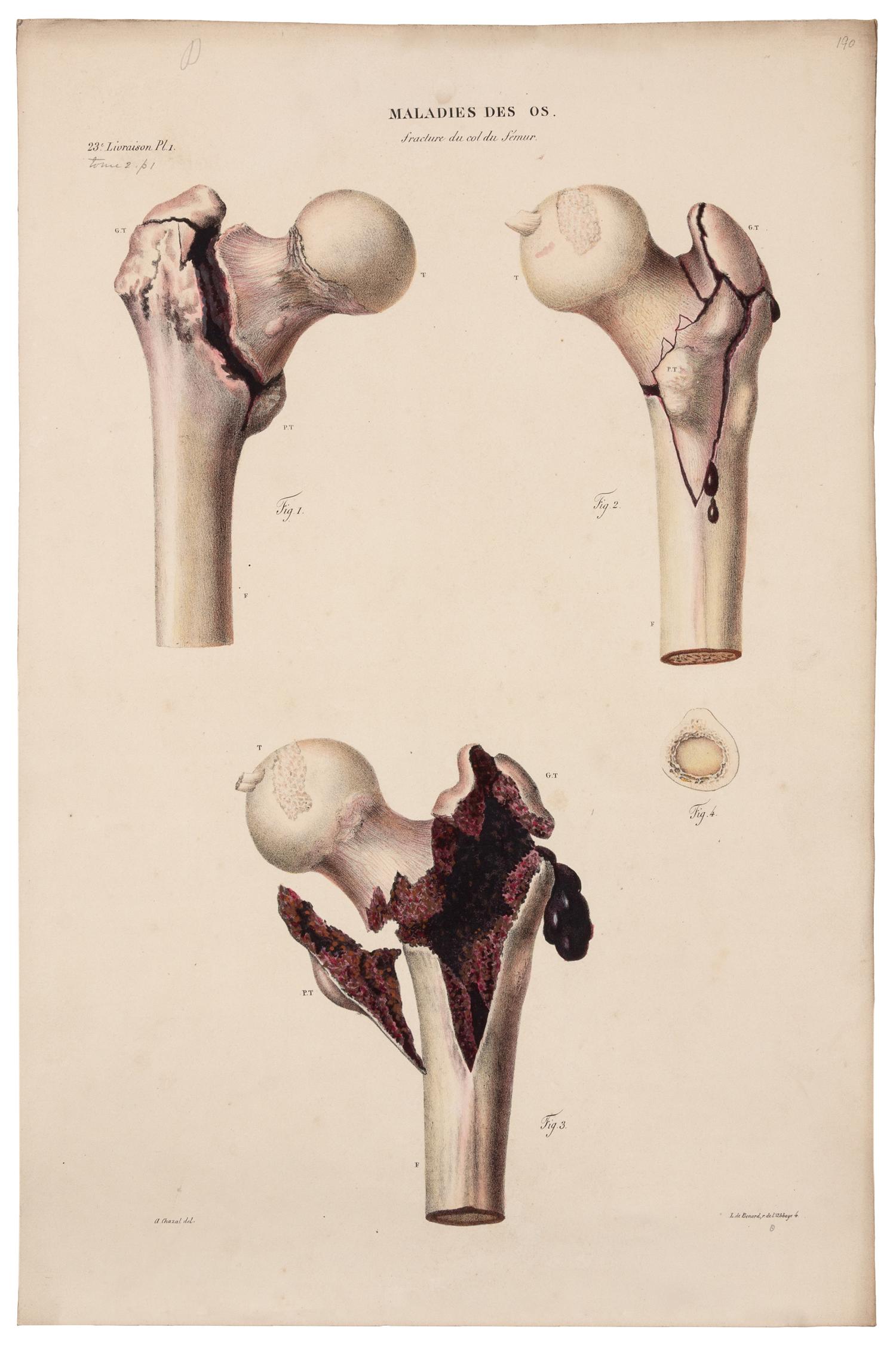 CRUVEILHIER, Jean (1791-1874). Anatomie pathologique du corps humain. Paris: J.-B. Baillière, 1829-1842.