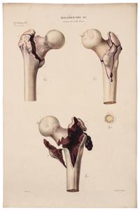 CRUVEILHIER, Jean (1791-1874). Anatomie pathologique du corps humain. Paris: J.-B. Baillière, 1829-1842.