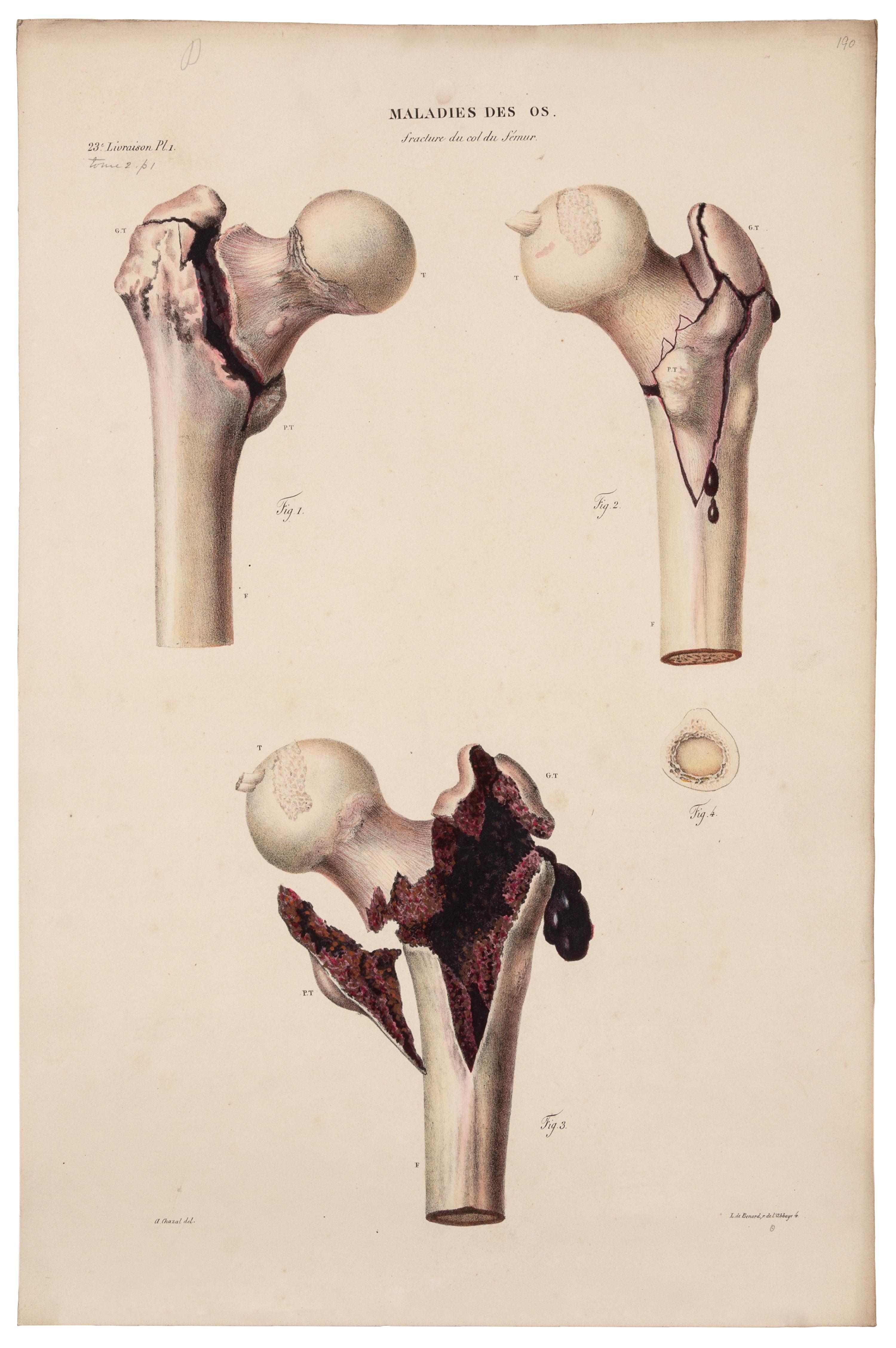 CRUVEILHIER, Jean (1791-1874). Anatomie pathologique du corps humain. Paris: J.-B. Baillière, 1829-1842.