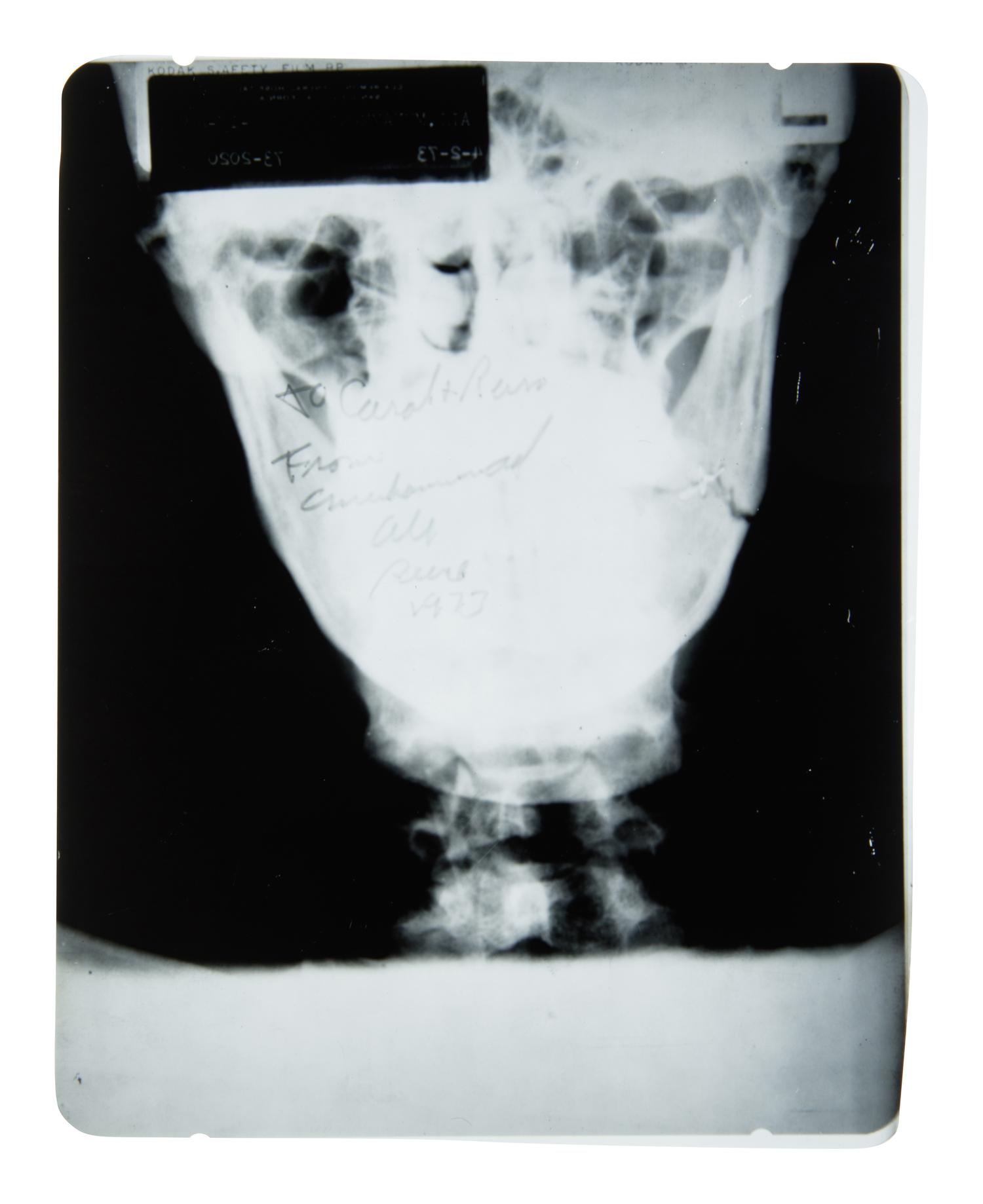 A Muhammad Ali Broken Jaw X-Ray Image From 1973 Ken Norton Fight,