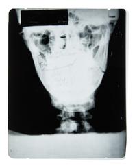 A Muhammad Ali Broken Jaw X-Ray Image From 1973 Ken Norton Fight,