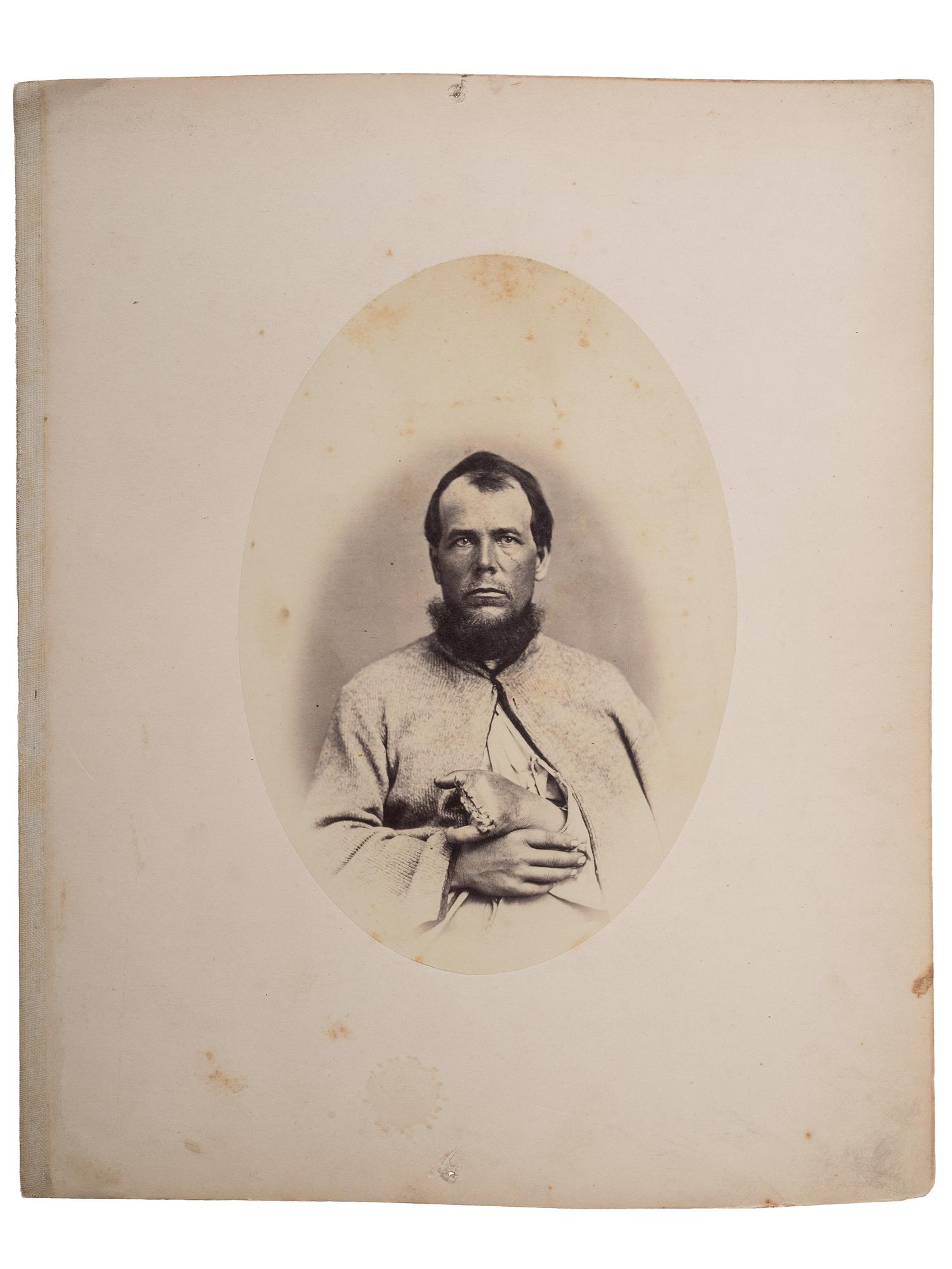[CIVIL WAR]. Albumen photograph of Private Rufus T. Giffin, Company M, 14th Regiment New York, Heavy Artillery, wounded Fort Steadman, Virginia, 25 March 1865, infection of left hand, photographed and assembled by Reed Brockway Bontecou, M.D.